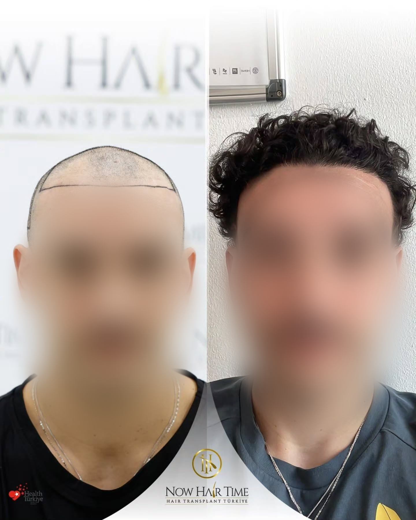 Before and After  graft    transplant at 