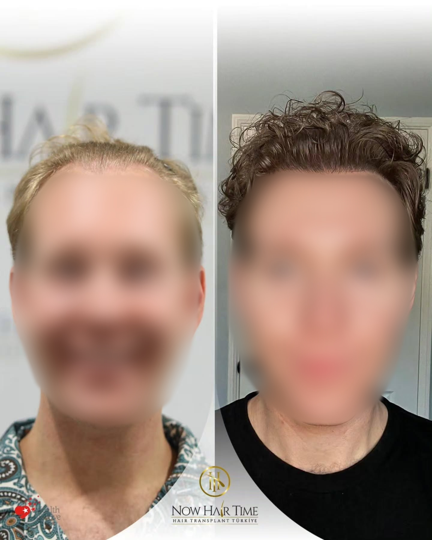4250 graft FUE hair transplant result before and after