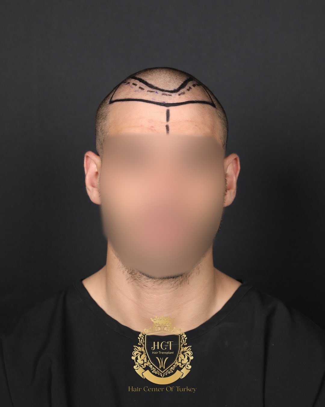 Before and After  graft    transplant at 