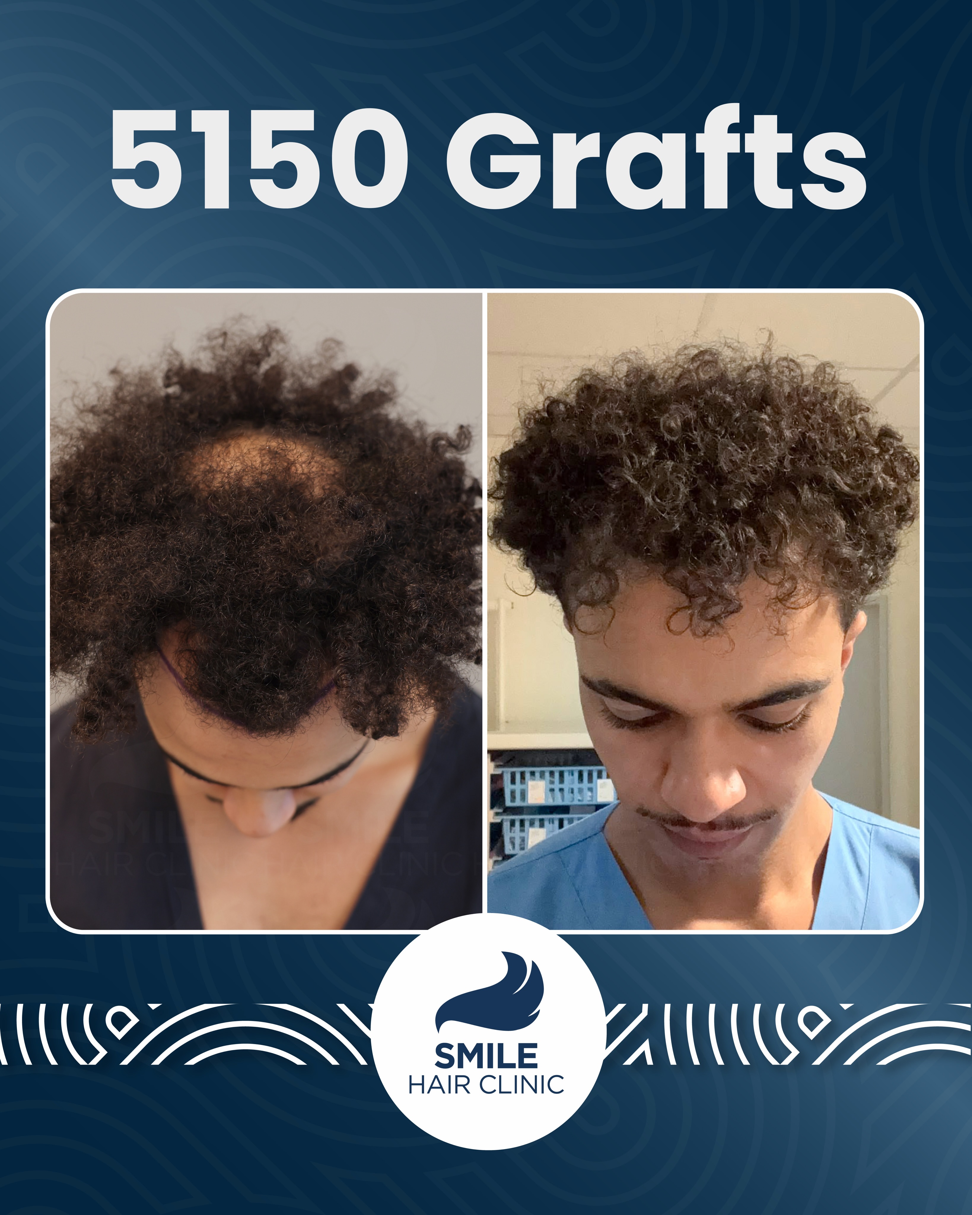Before and After  graft    transplant at 