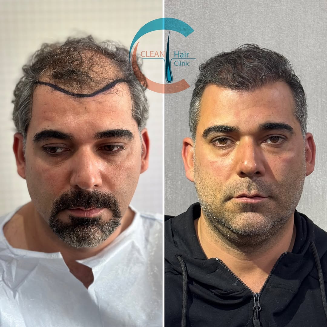 FUE Hair Transplant Result