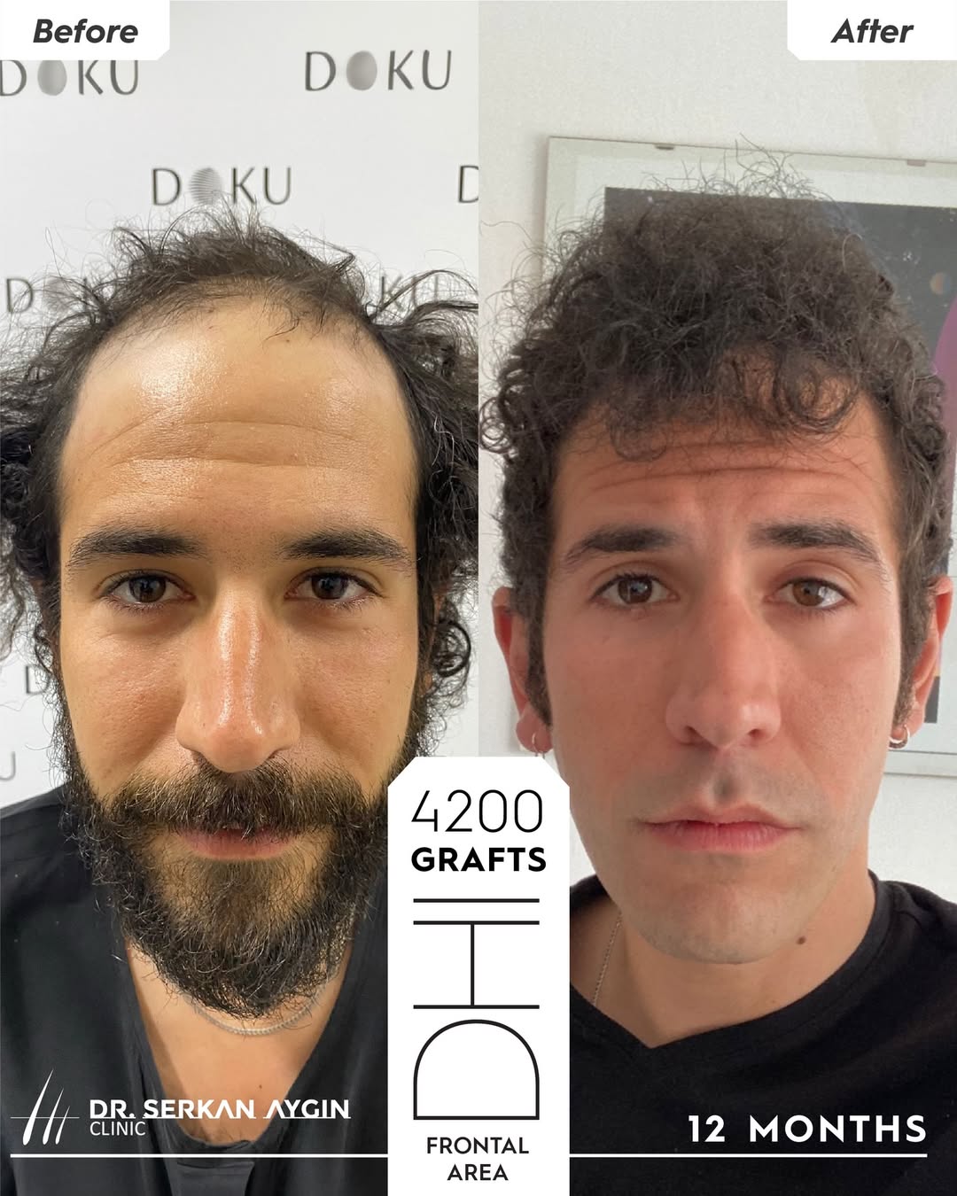 DHI Hair Transplant Result