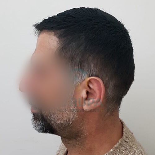 Before and After  graft    transplant at 