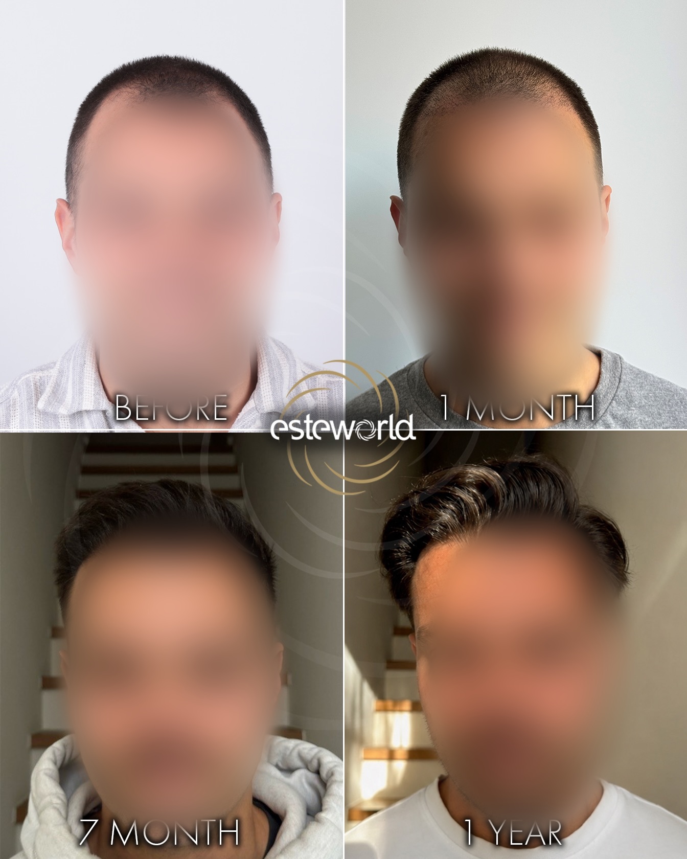3600 grafts DHI hair transplant result before and after