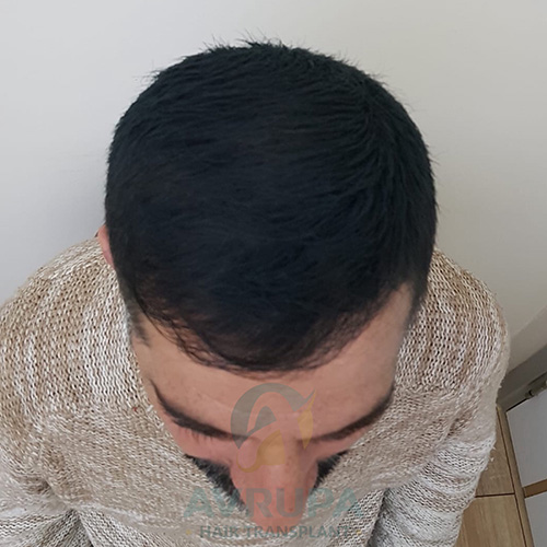 Before and After  graft    transplant at 