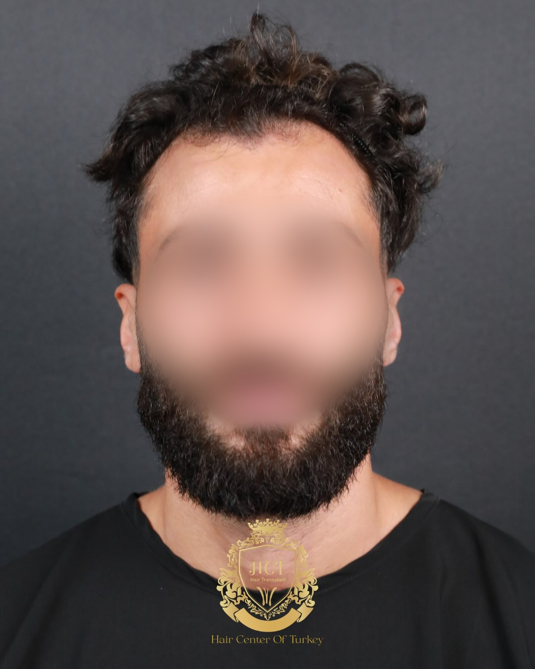 Before and After 4200 graft  SAFIR hair transplant at Hair Center Of Turkey