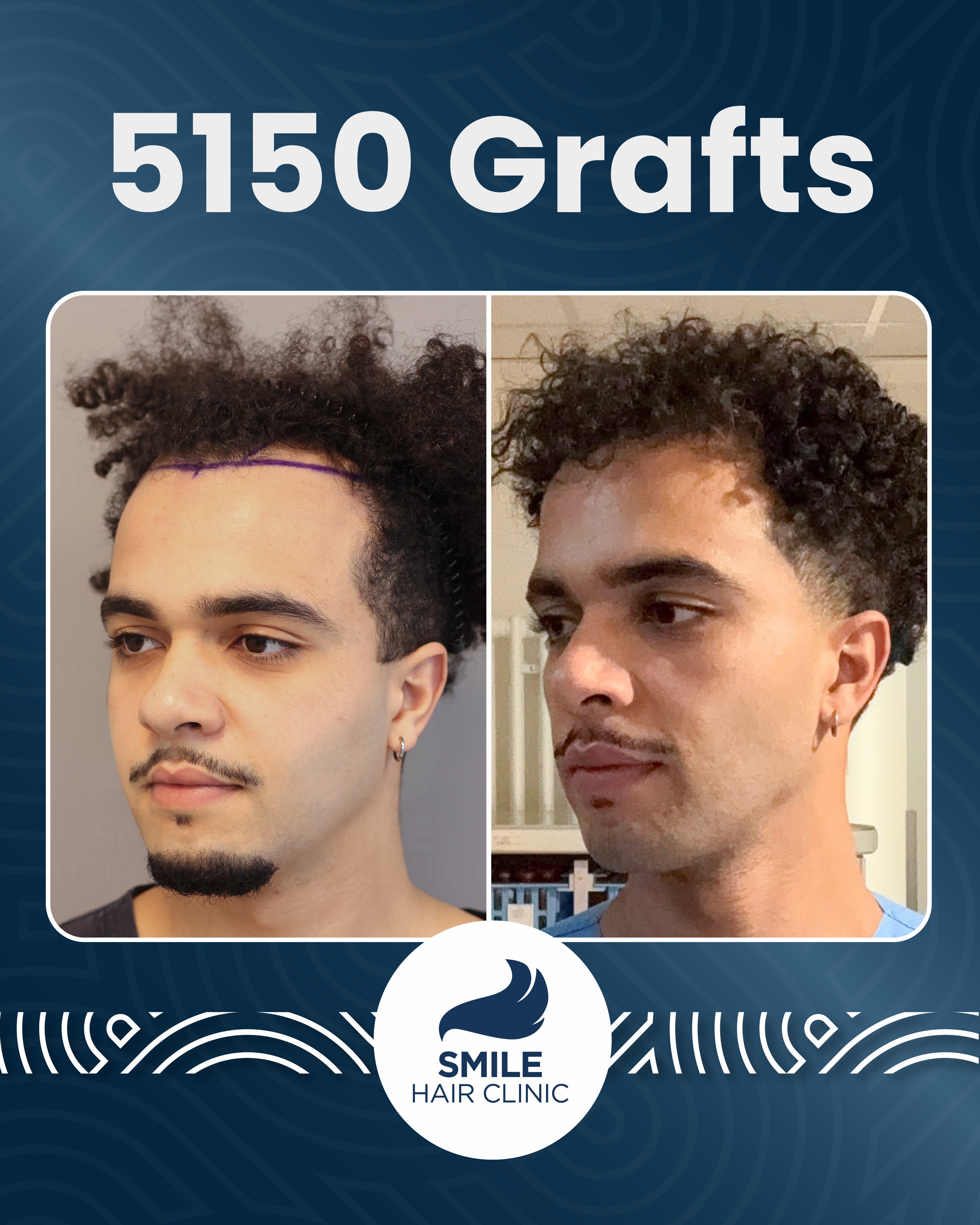 Before and After  graft    transplant at 