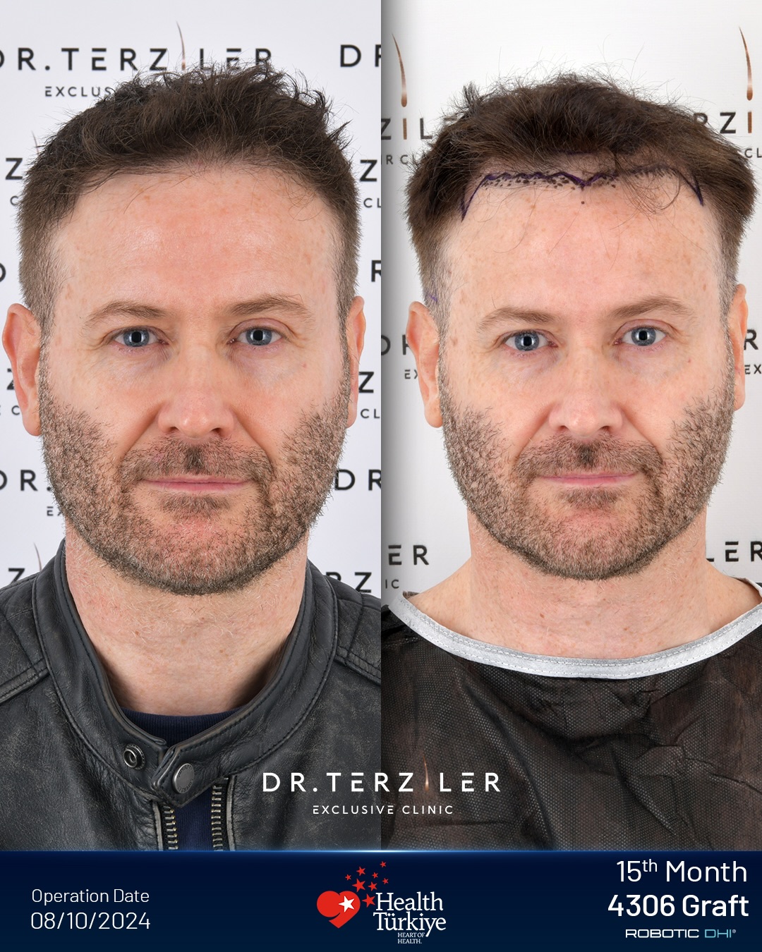 DHI Hair Transplant Result