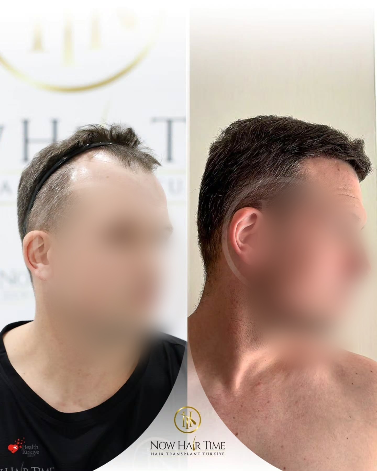 5400 graft SAFIR hair transplant result before and after