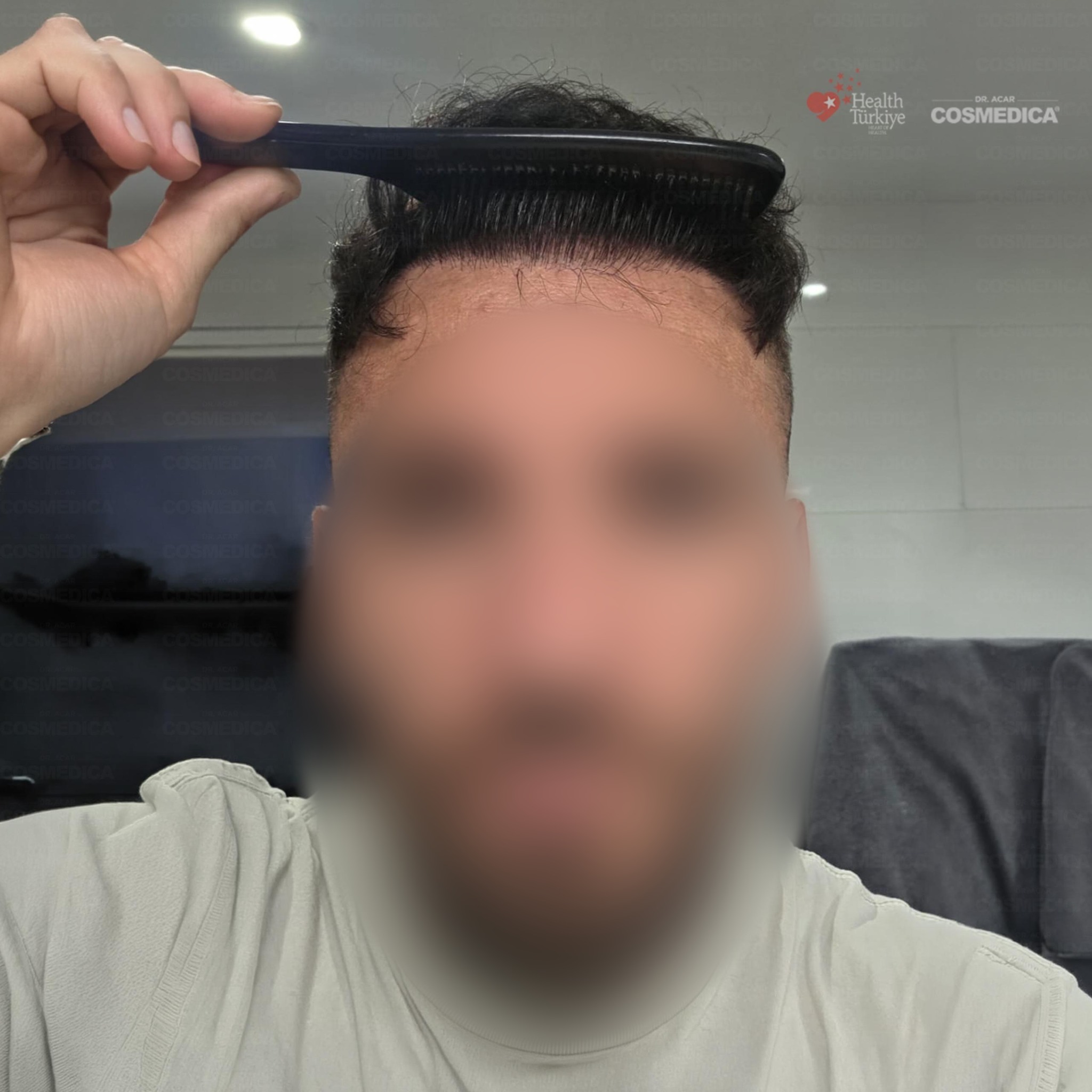 5500 graft DHI hair transplant result before and after