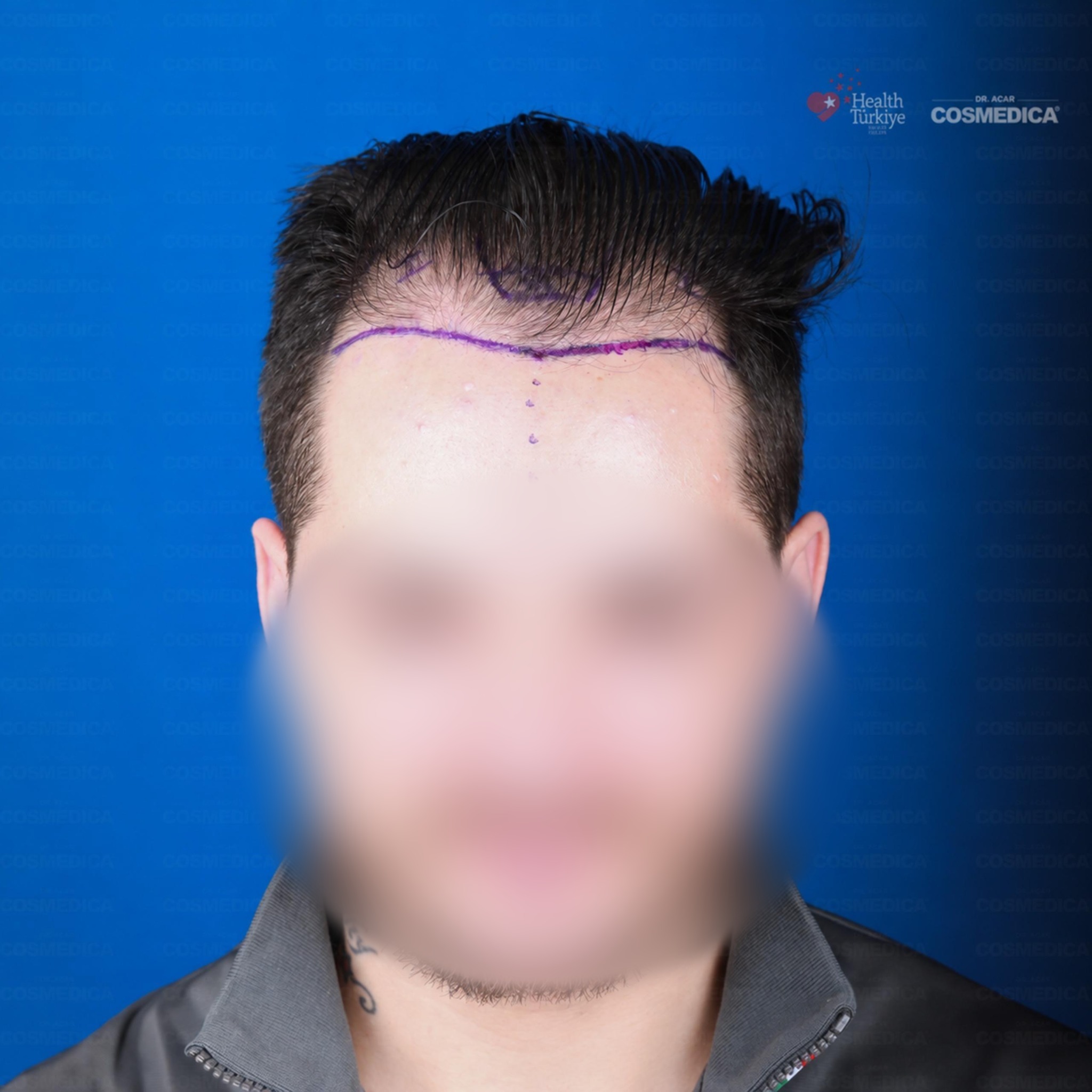 Before and After  graft    transplant at 