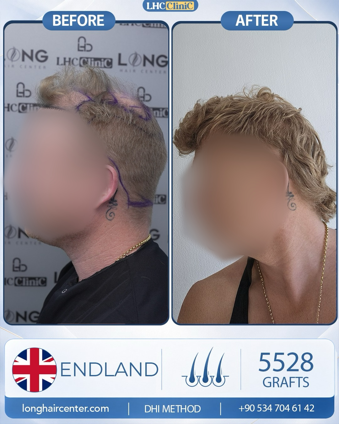 5528 graft DHI hair transplant result before and after