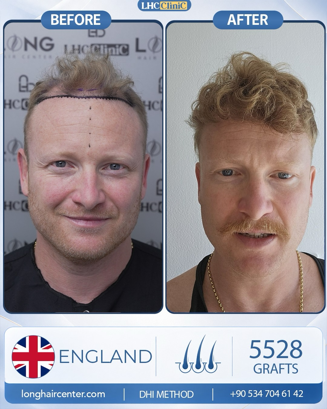 Before and After  graft    transplant at 