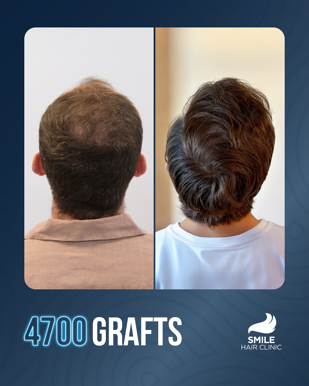 Before and After  graft    transplant at 