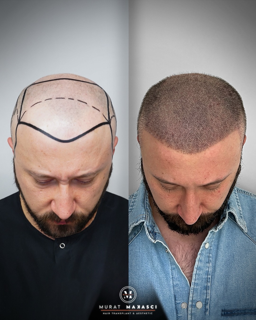Before and After  graft    transplant at 
