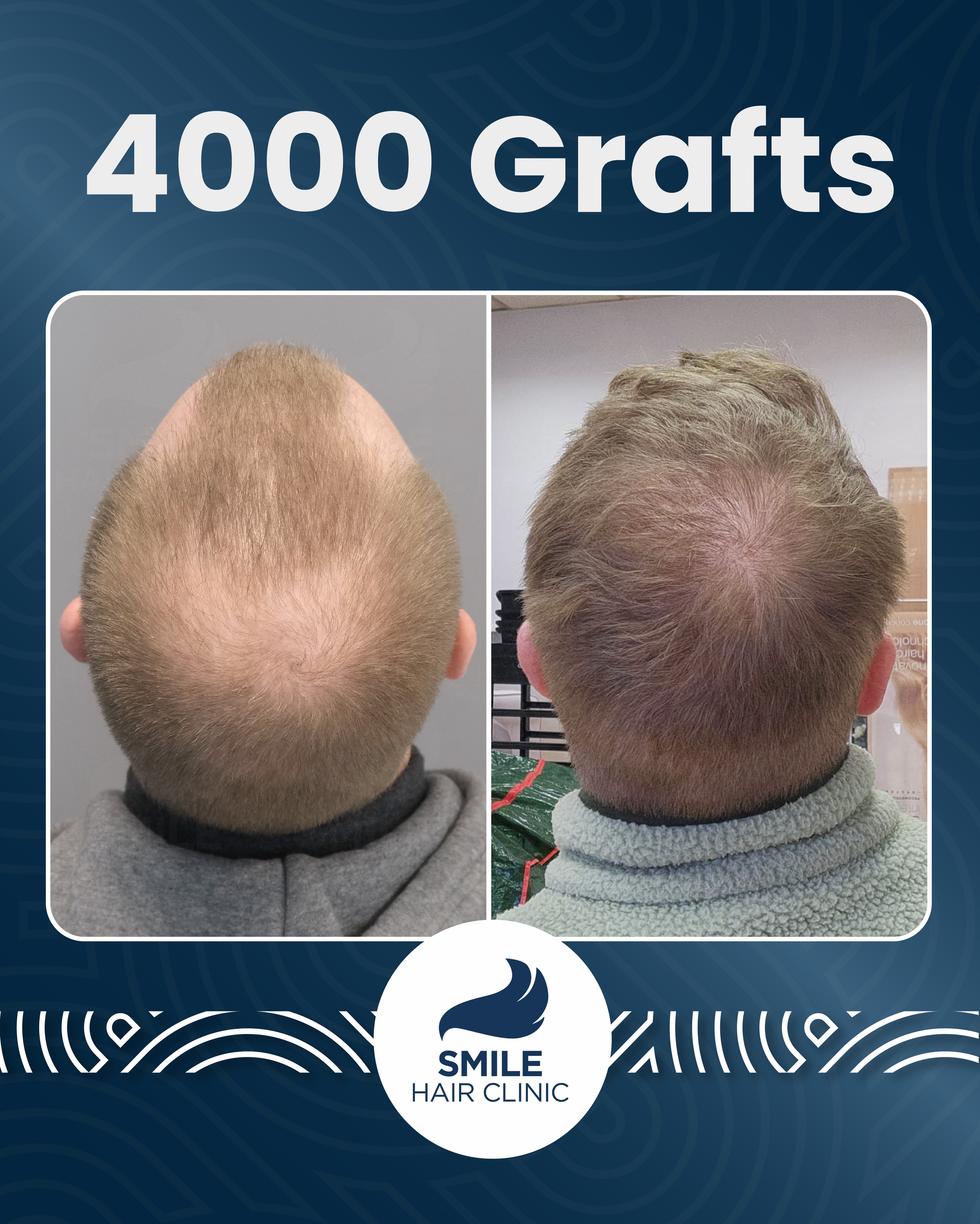 Before and After  graft    transplant at 