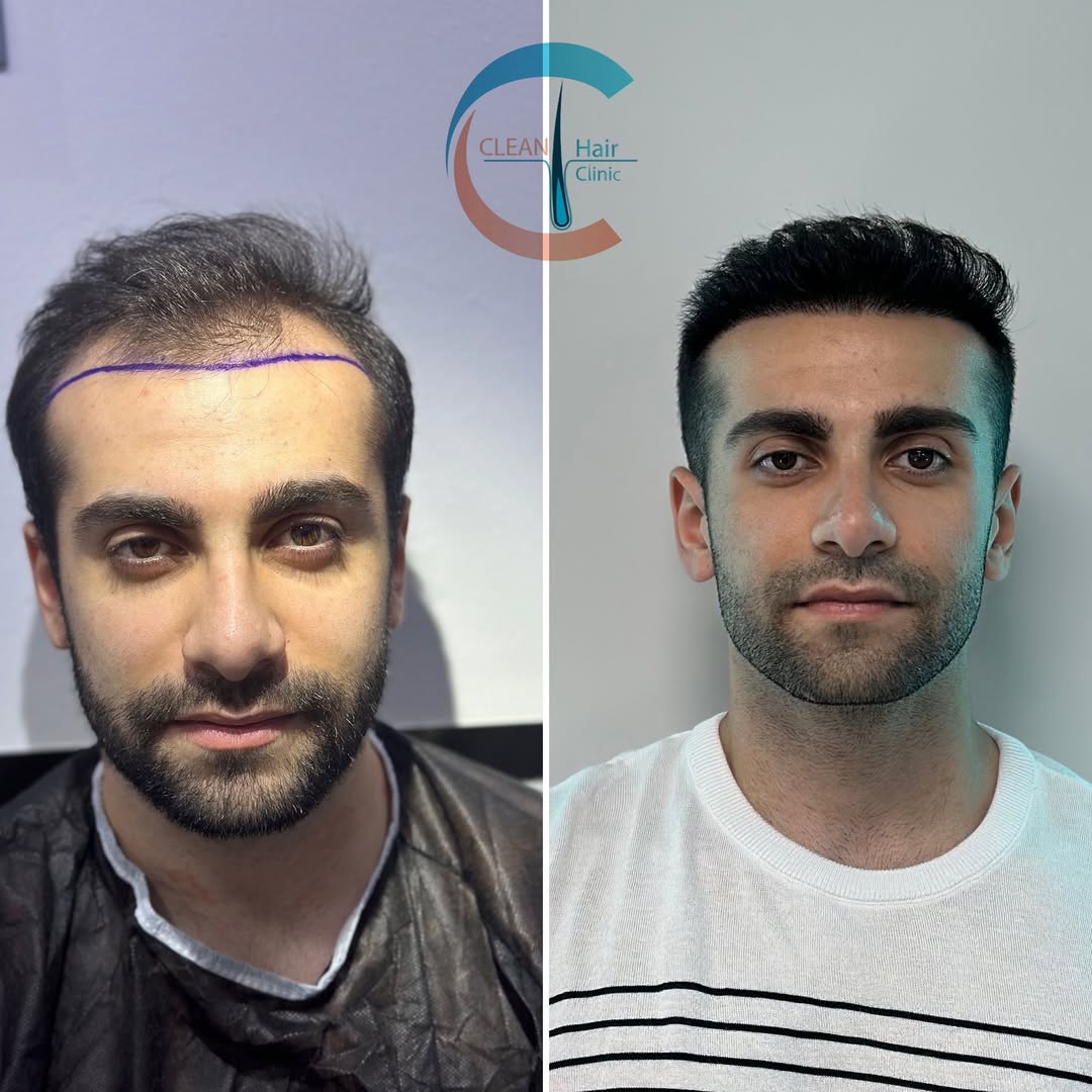 FUE Hair Transplant Result
