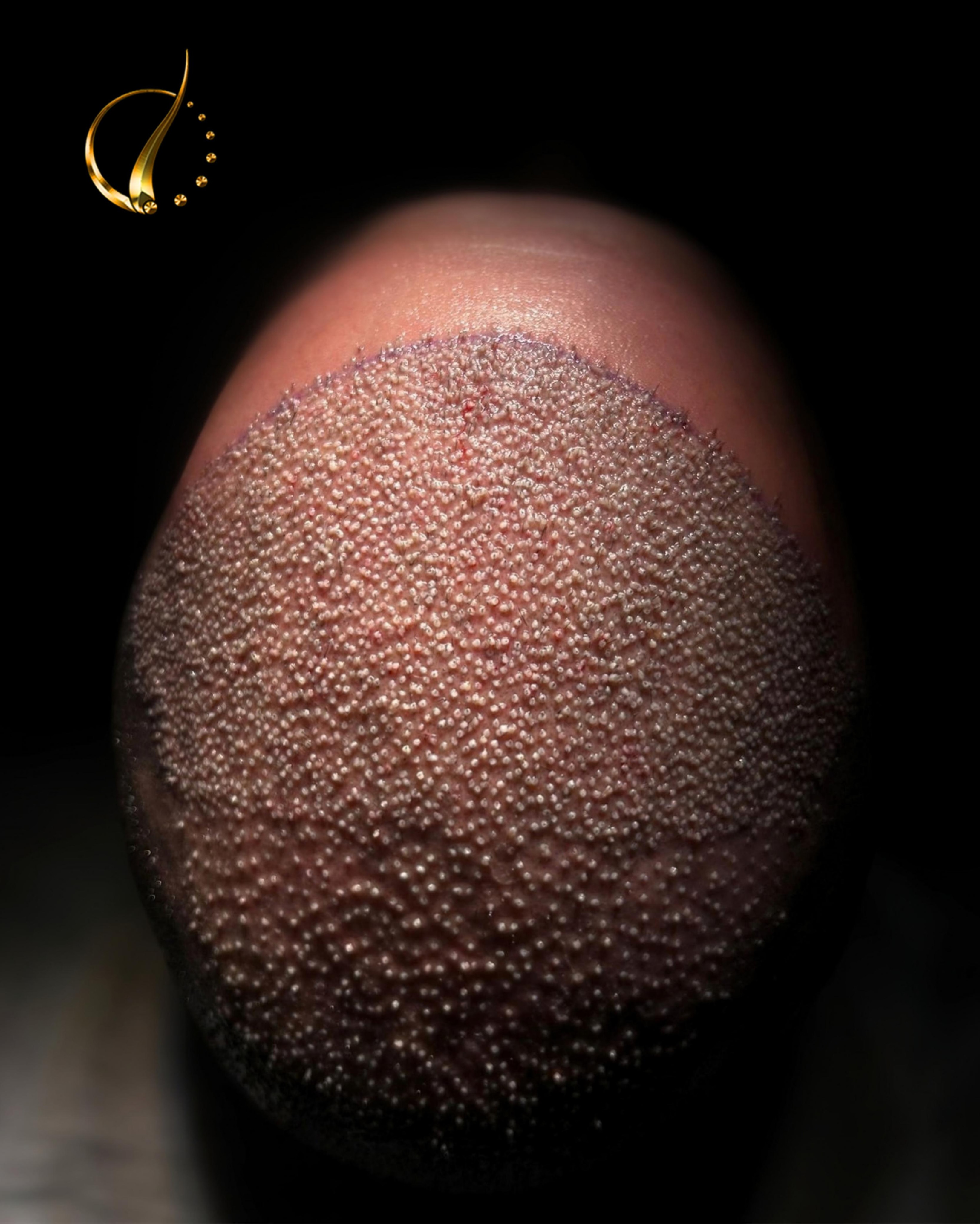 Before and After  graft    transplant at 
