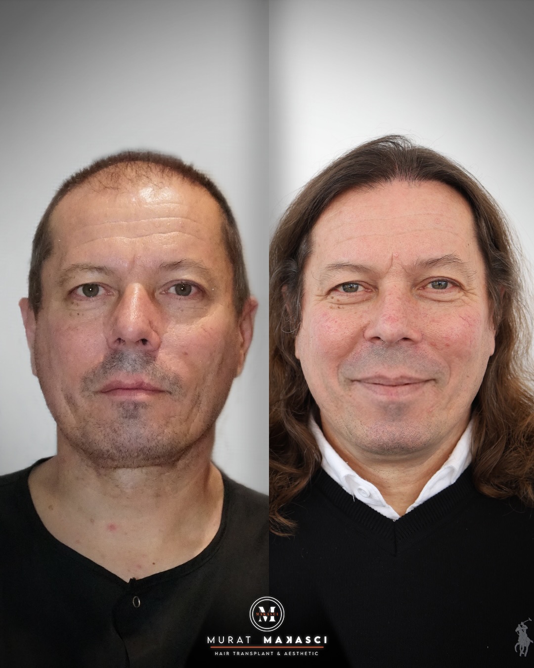 5800 grafts FUE hair transplant result before and after