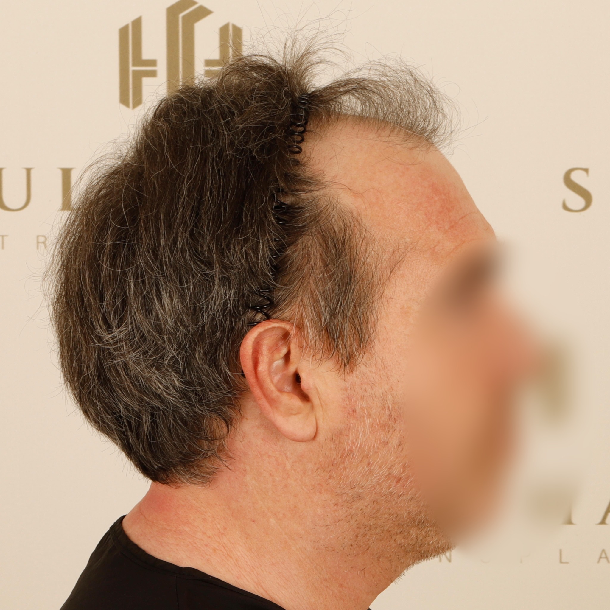 Before and After  graft    transplant at 