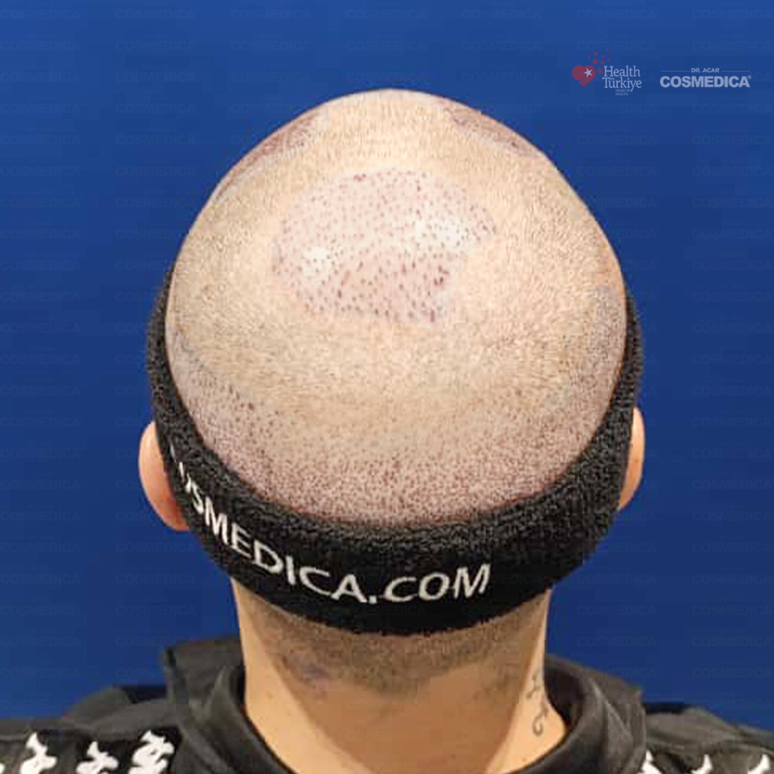 Before and After  graft    transplant at 