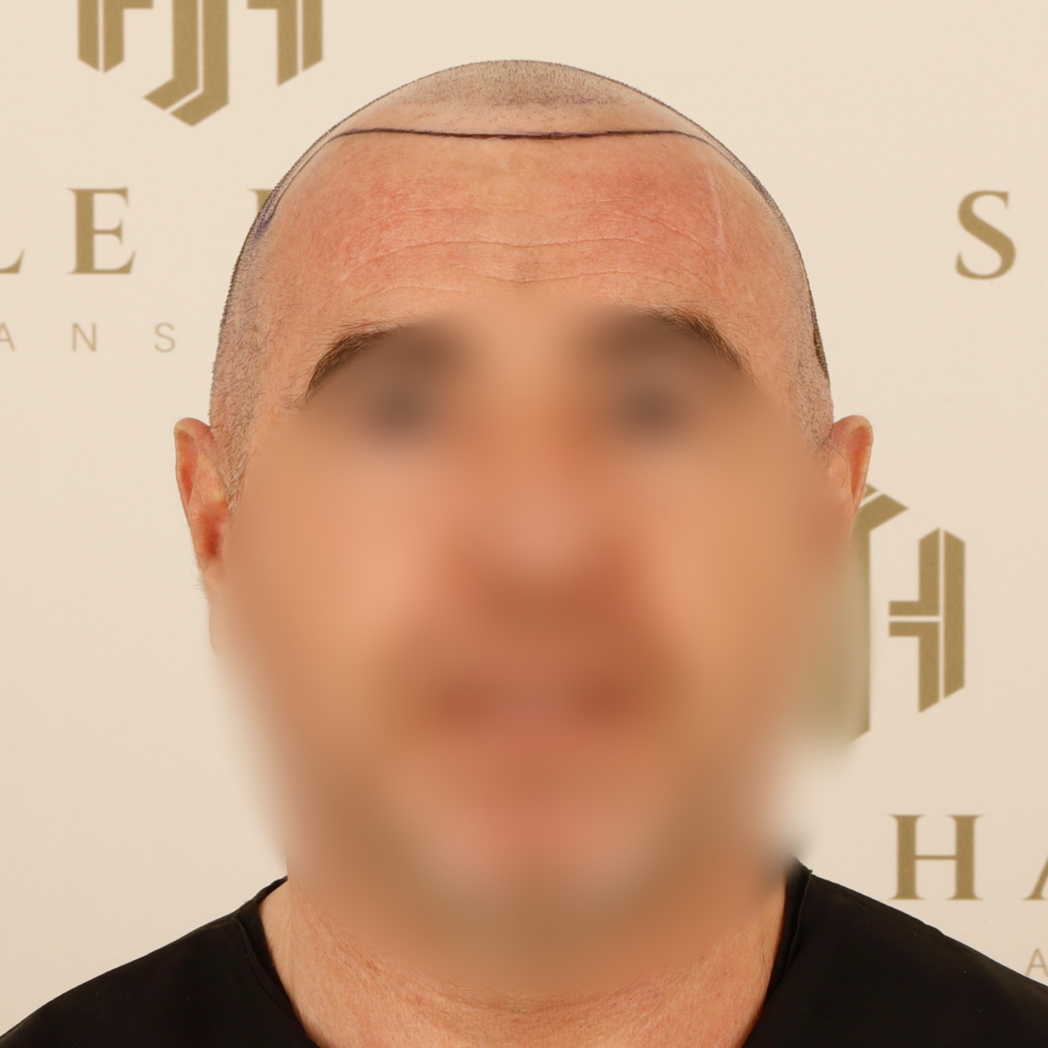 Before and After  graft    transplant at 