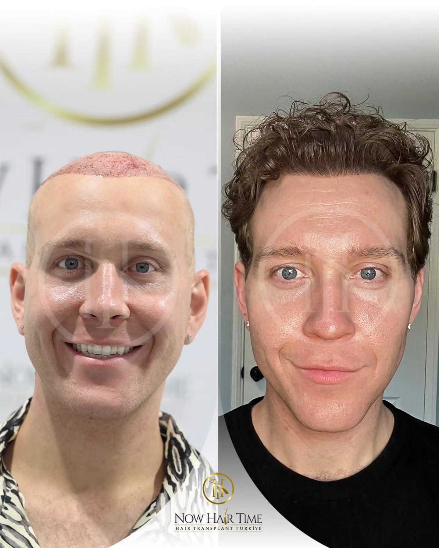 Before and After  graft    transplant at 