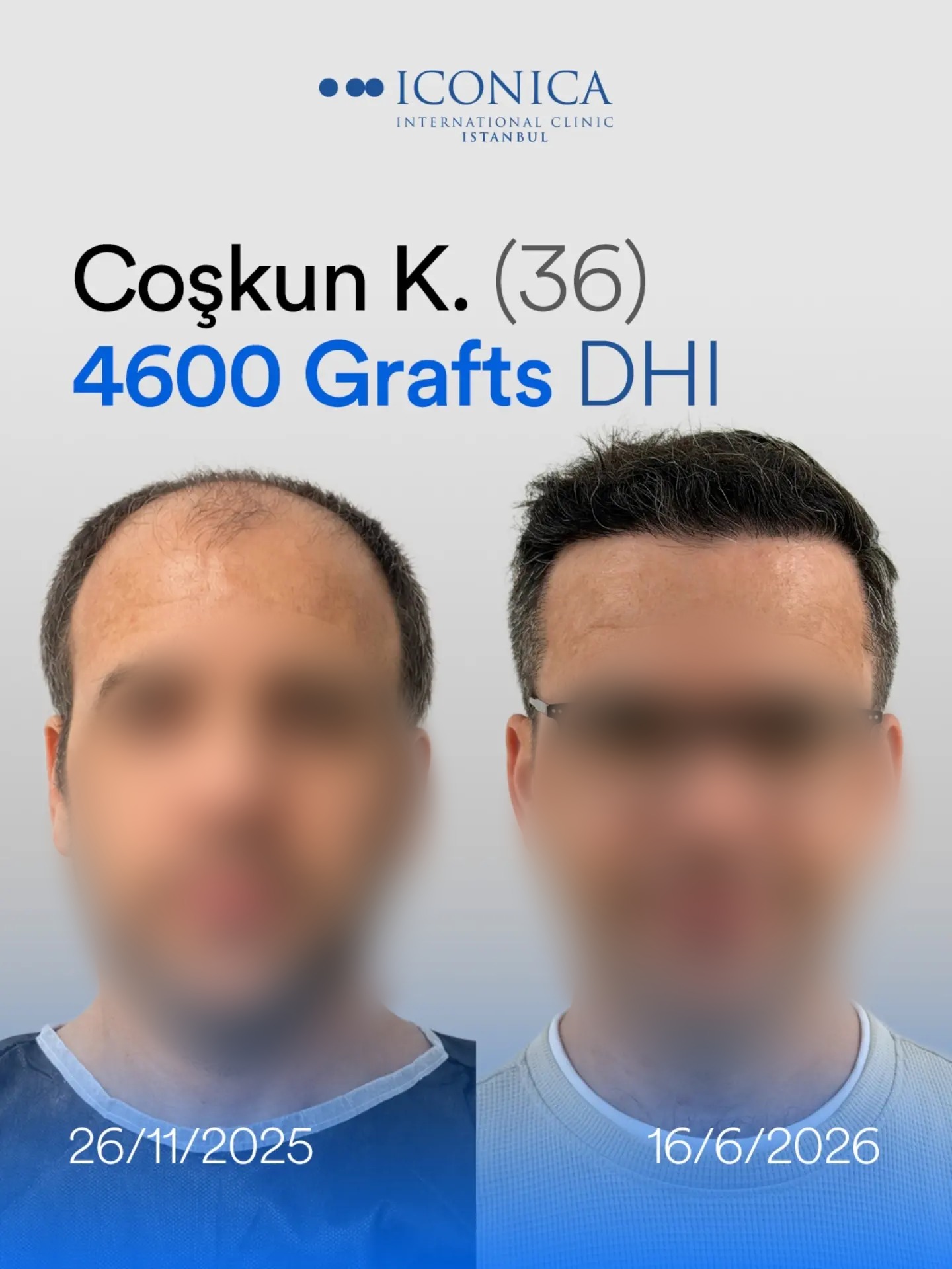 4600 graft DHI hair transplant result before and after