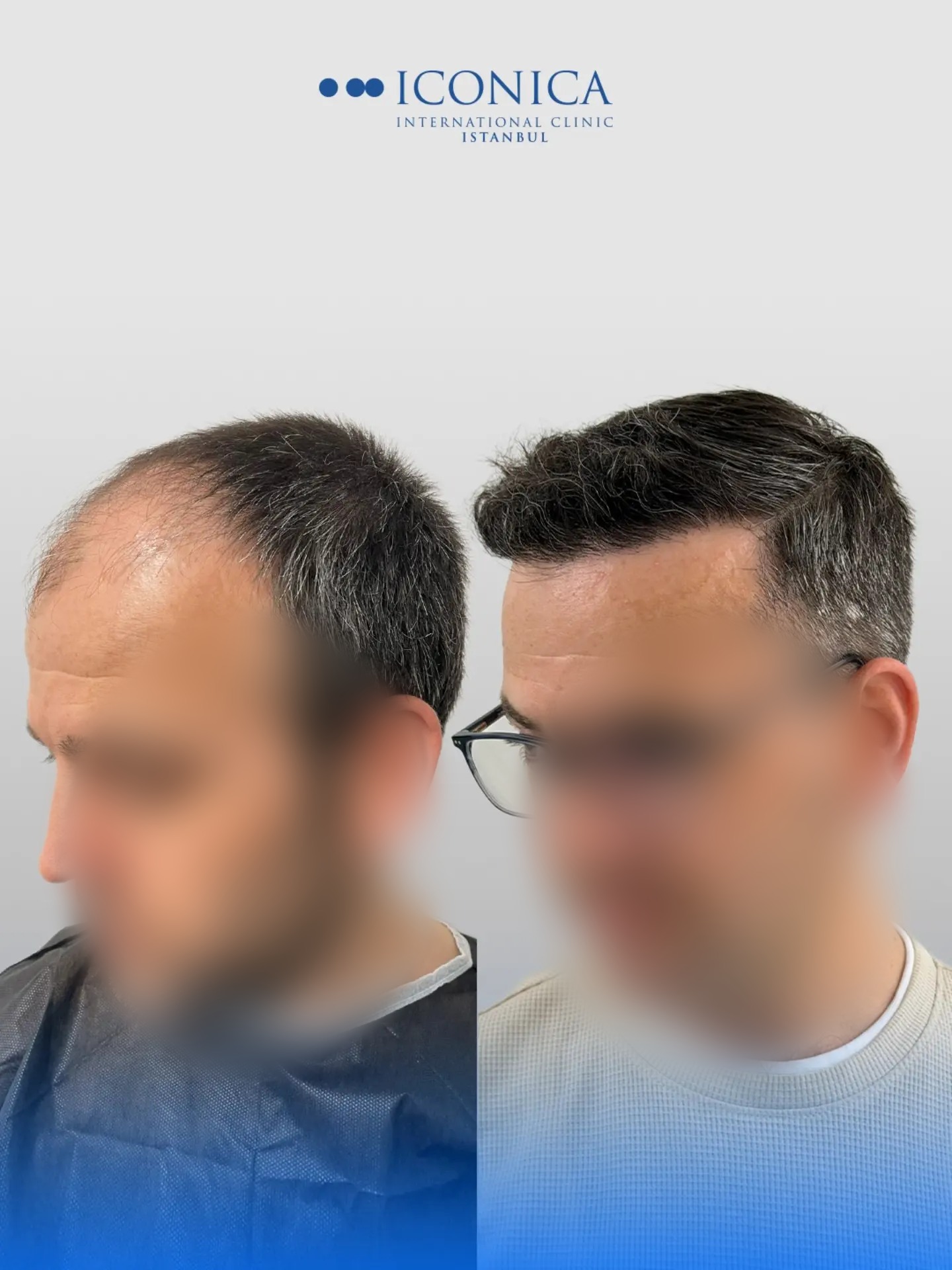 Before and After  graft    transplant at 