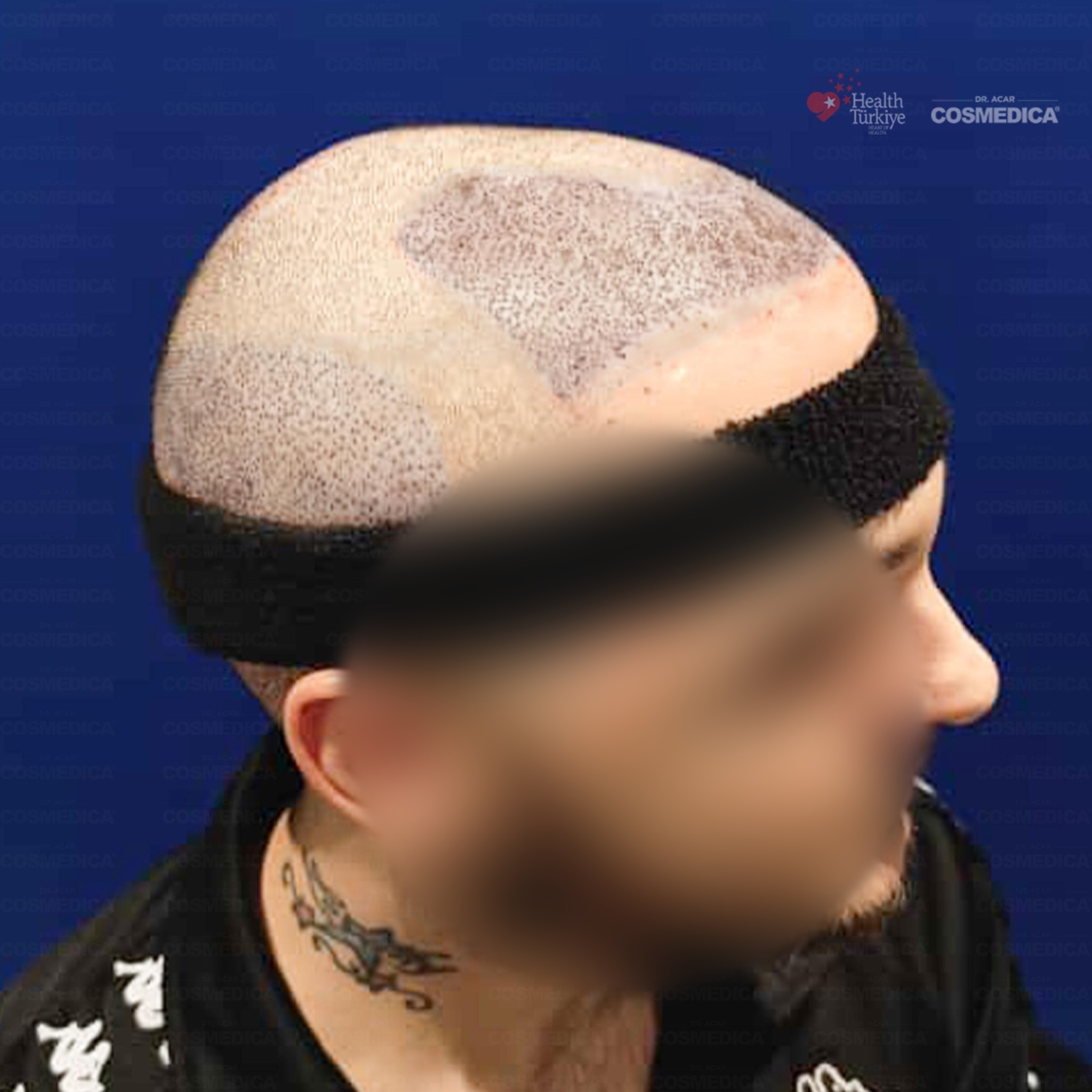 Before and After  graft    transplant at 