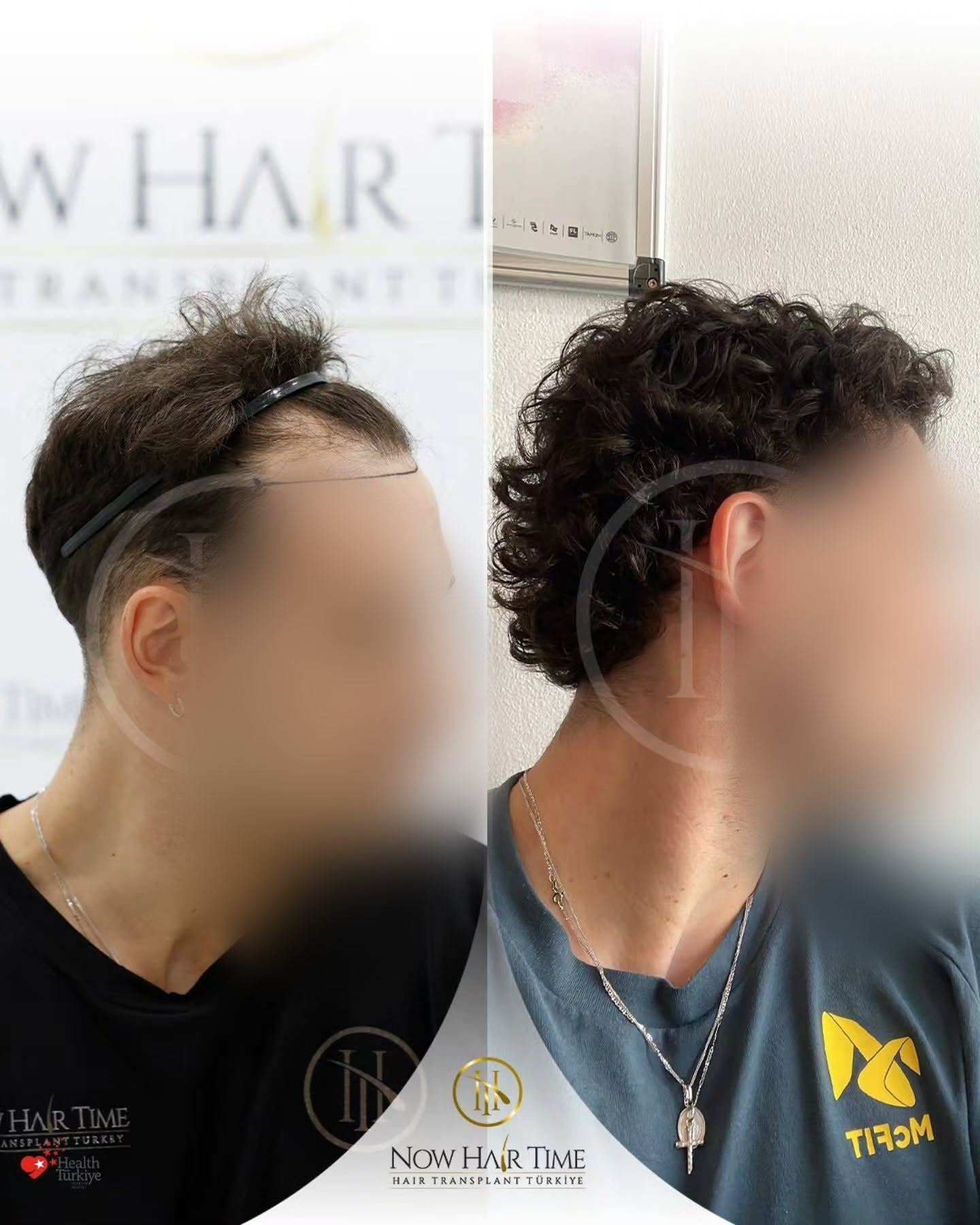 Before and After  graft    transplant at 