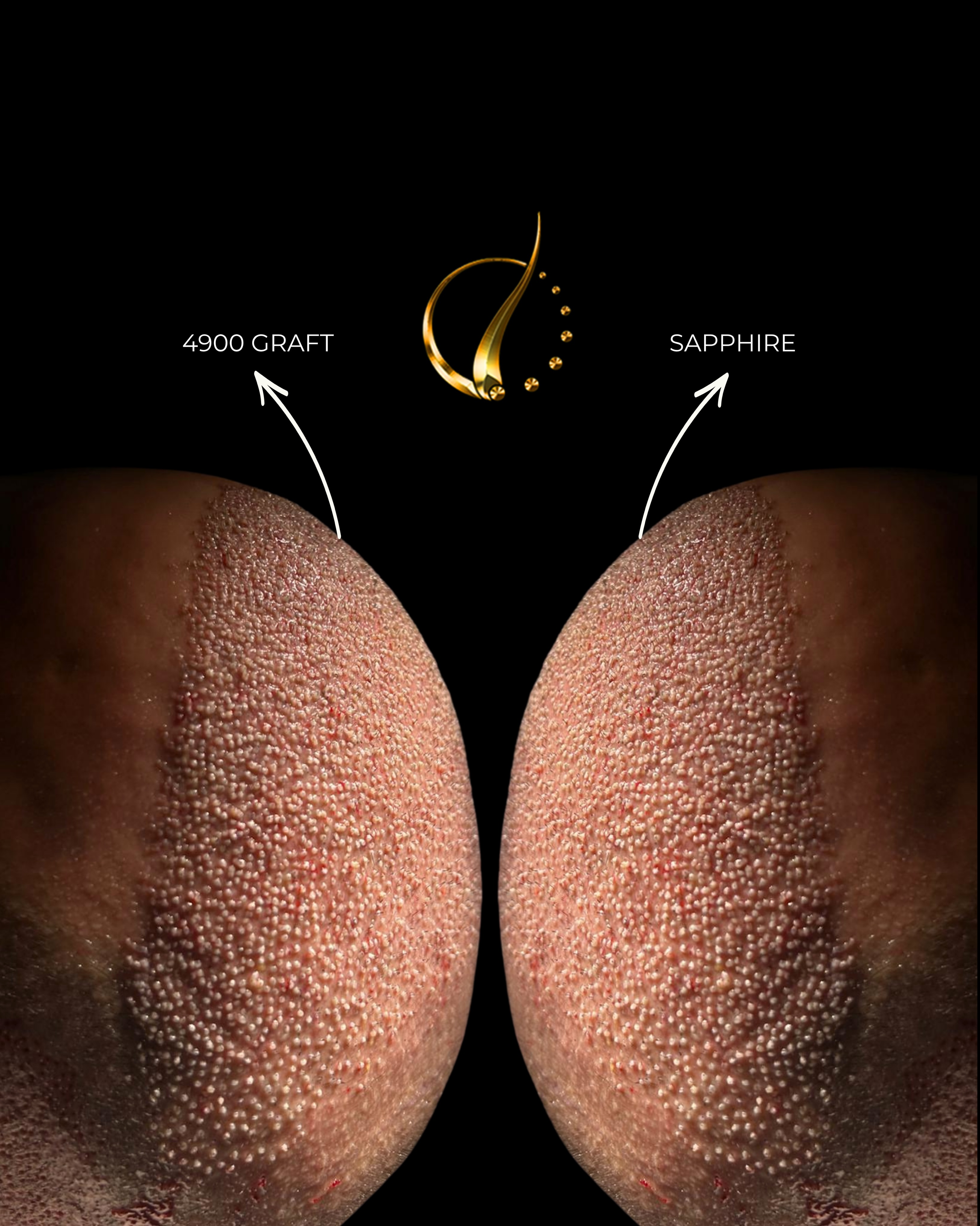 Before and After  graft    transplant at 