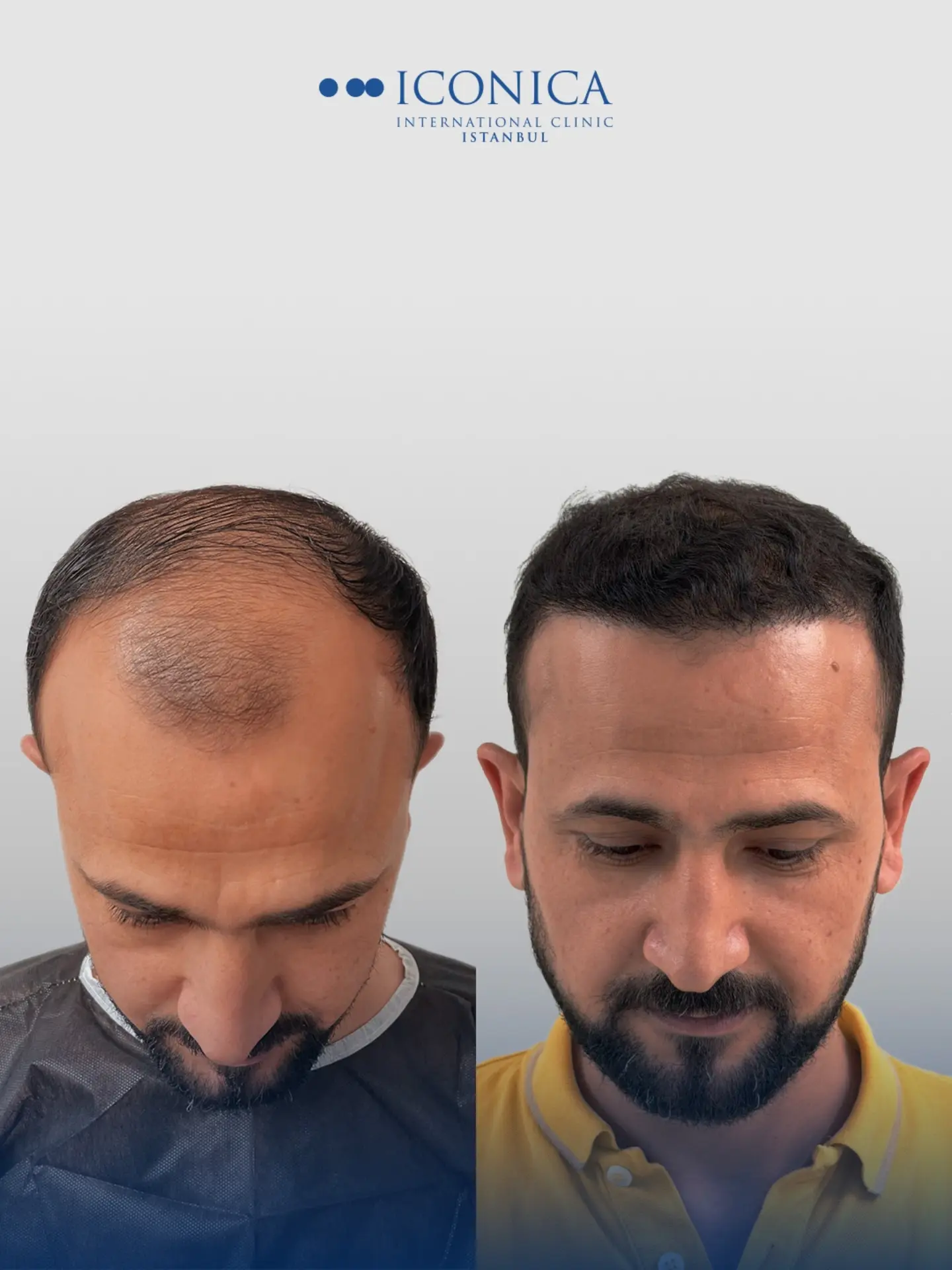 Before and After  graft    transplant at 