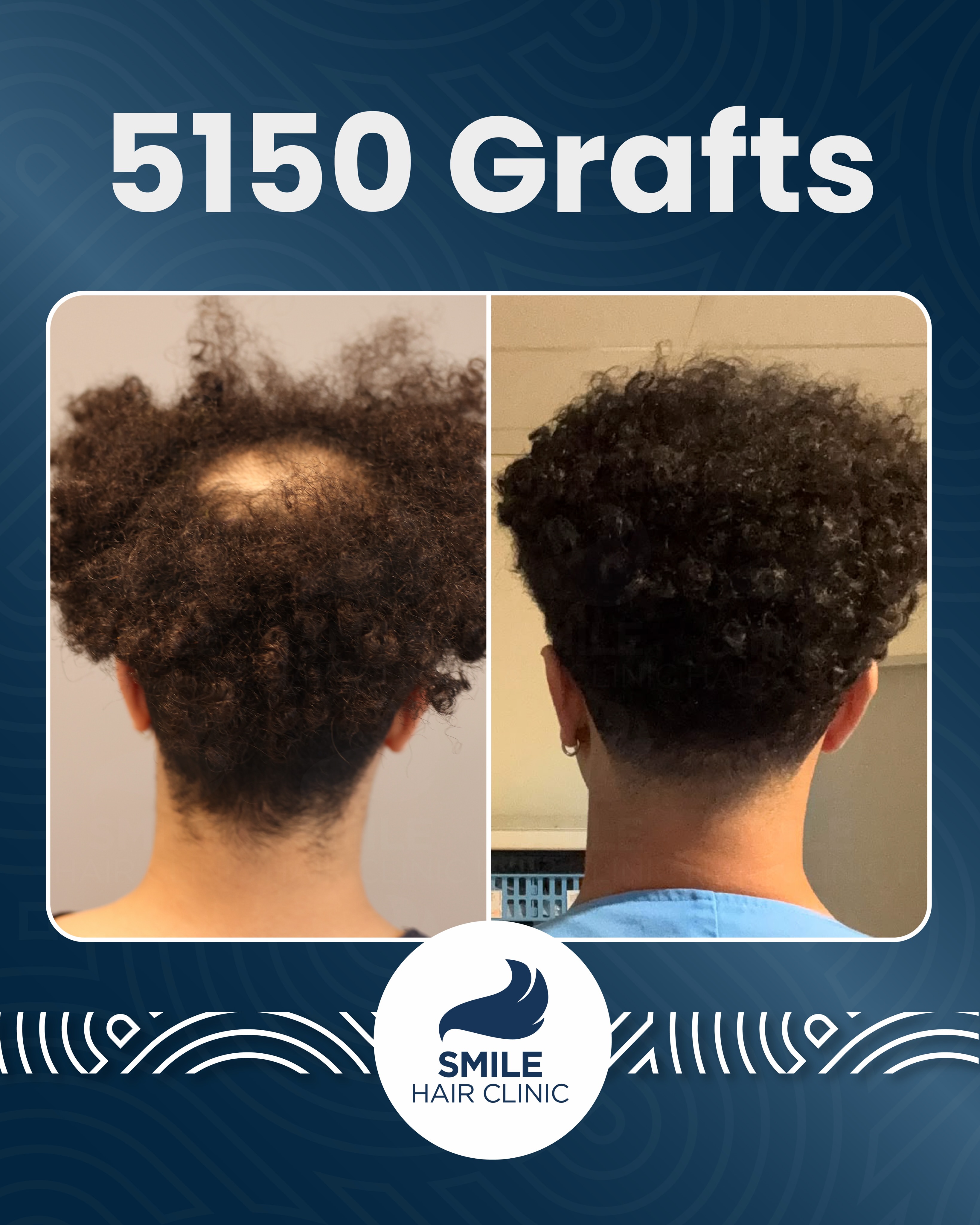 Before and After  graft    transplant at 