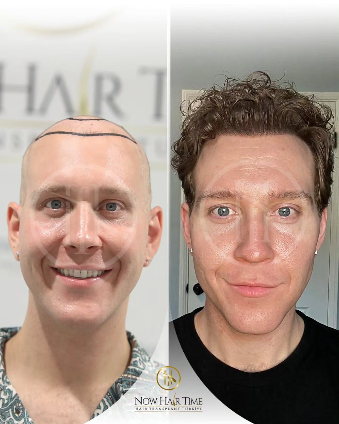 Before and After  graft    transplant at 