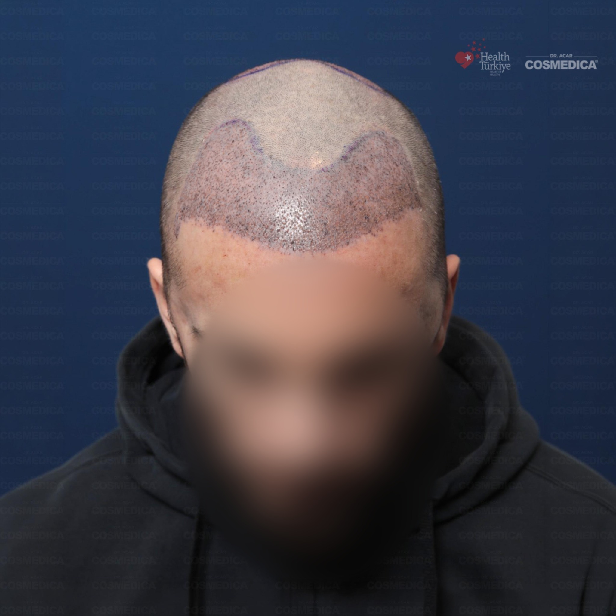 Before and After  graft    transplant at 