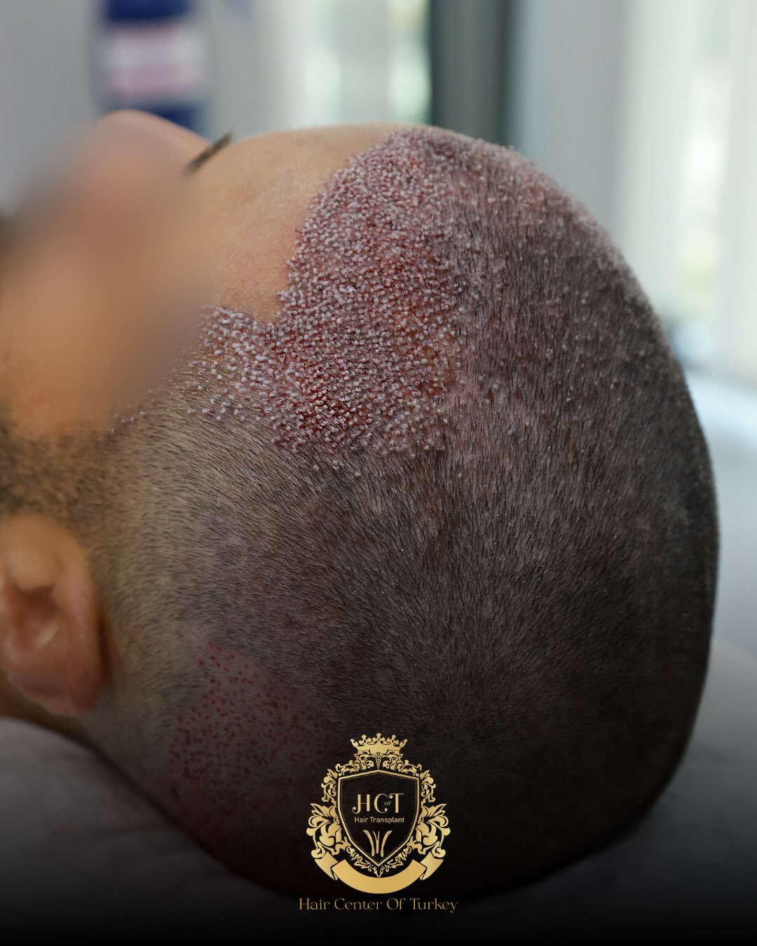 Before and After  graft    transplant at 