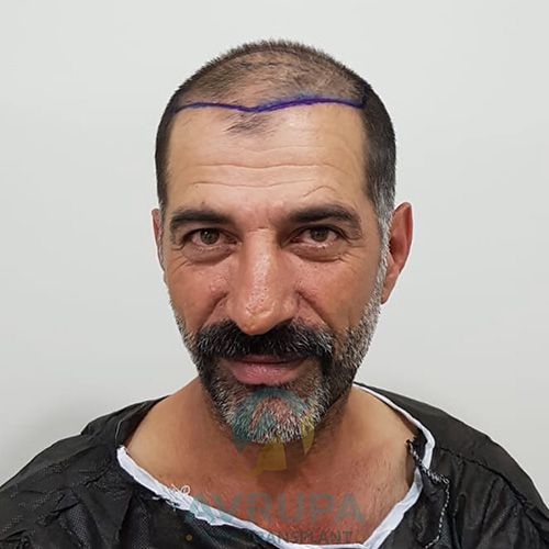 FUE Hair Transplant Result