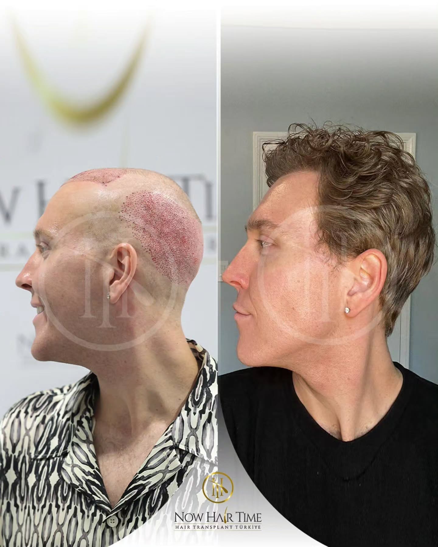 Before and After  graft    transplant at 