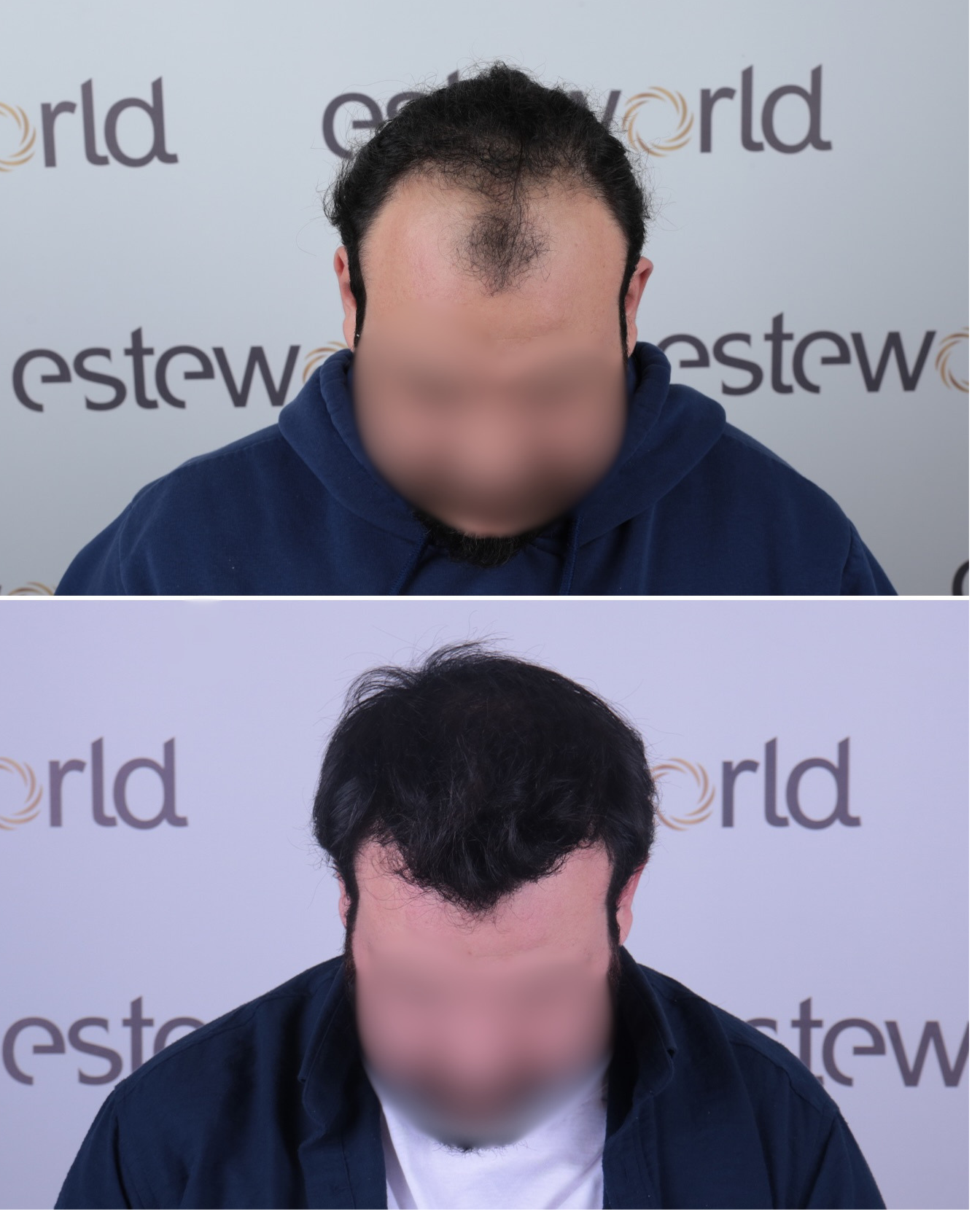 4570 graft DHI hair transplant result before and after