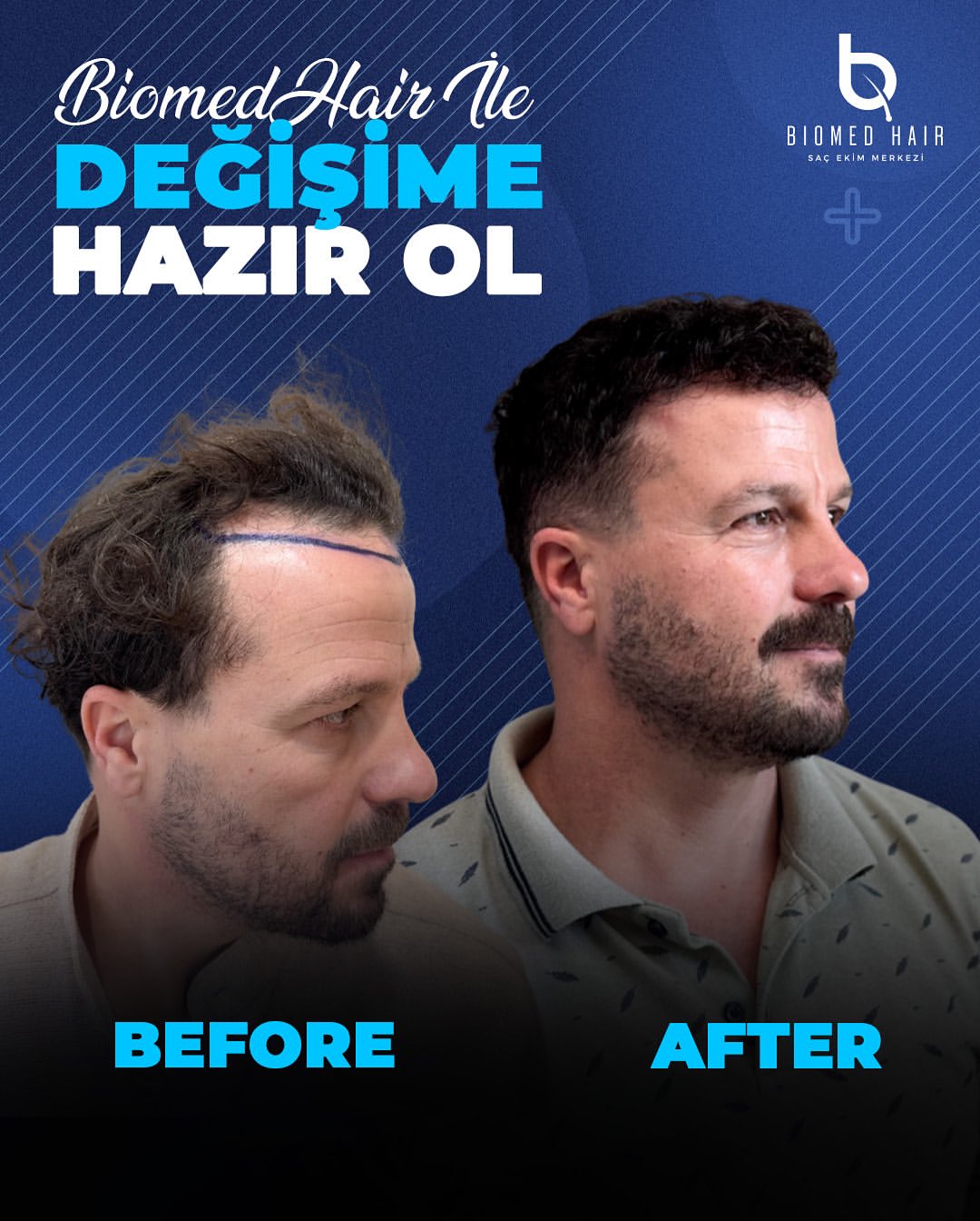 FUE Hair Transplant Result