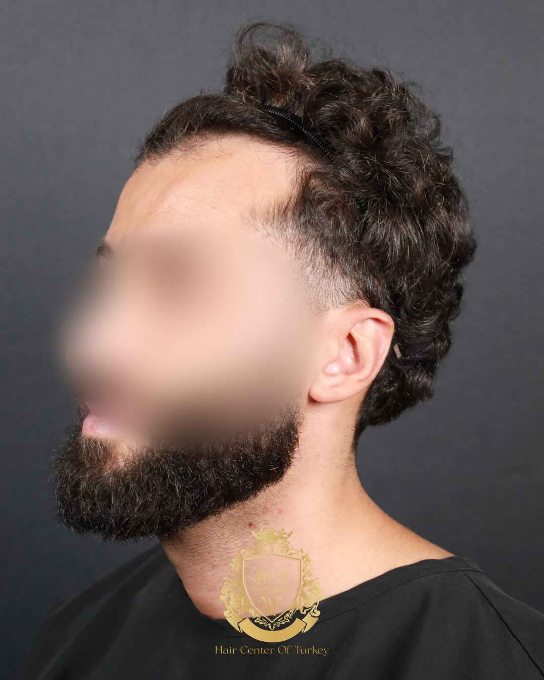 4200 graft SAFIR hair transplant result before and after