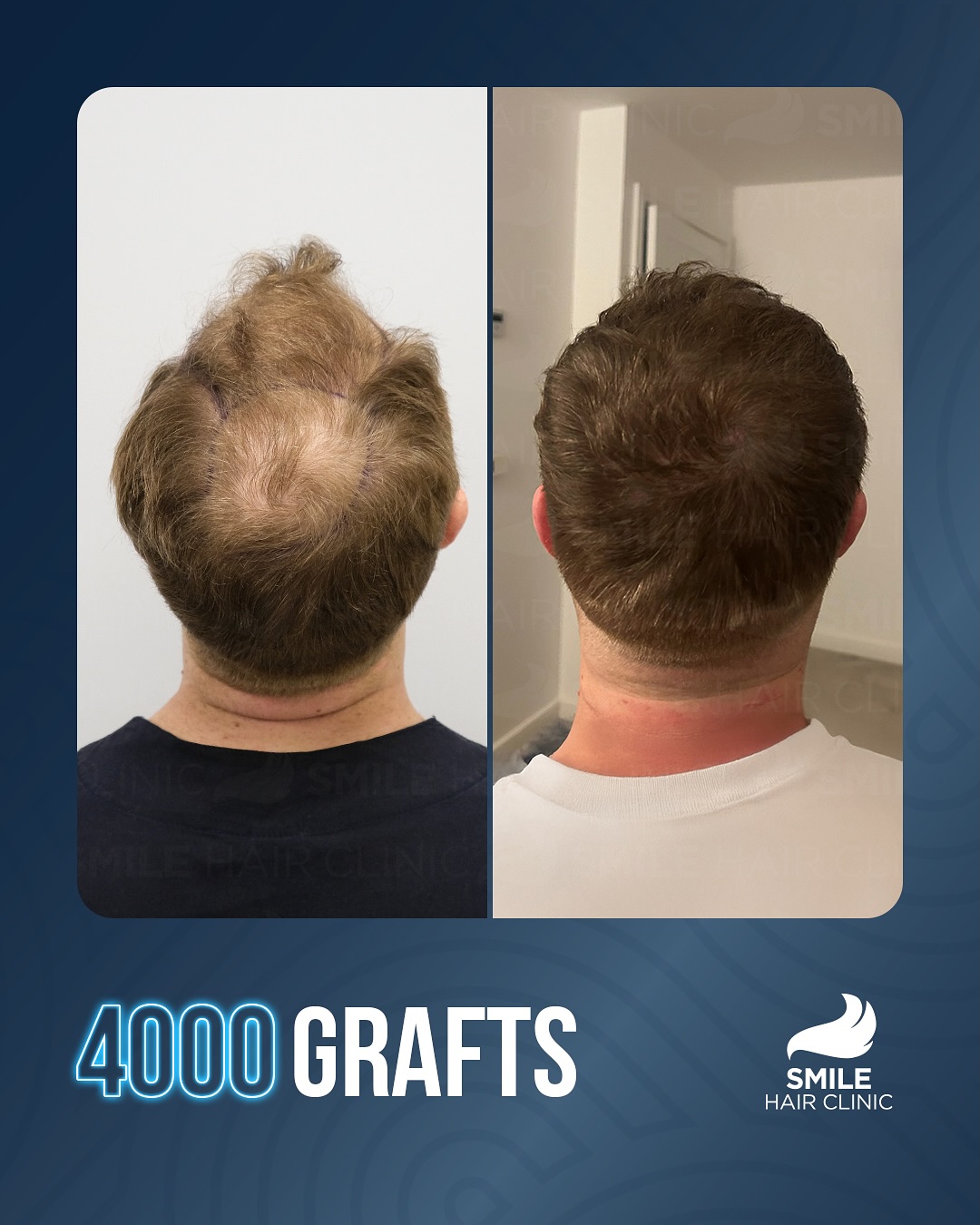 Before and After 4000 graft  FUE hair transplant at Smile Hair Clinic Hair Transplant Turkey Istanbul