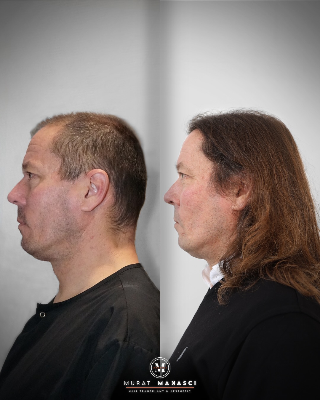 Before and After  graft    transplant at 