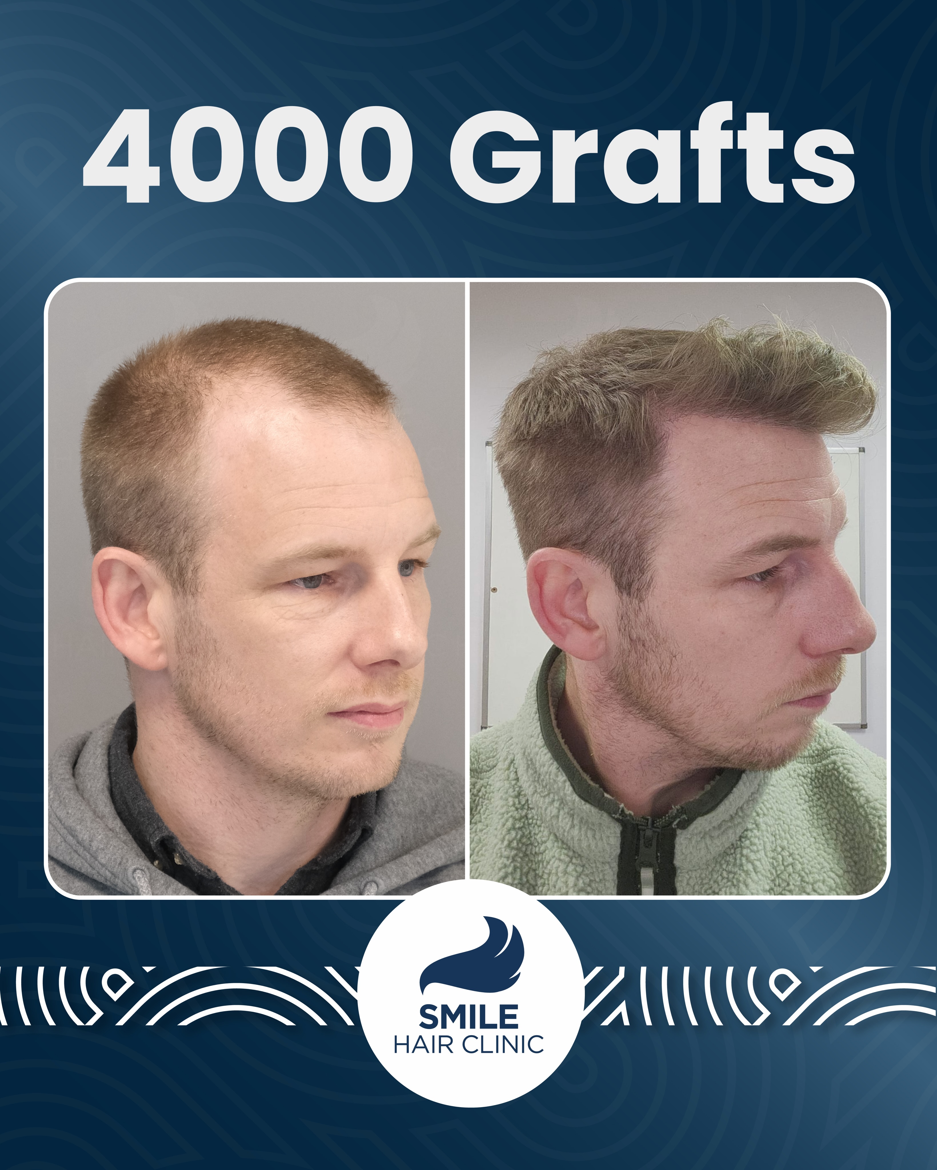 Before and After  graft    transplant at 