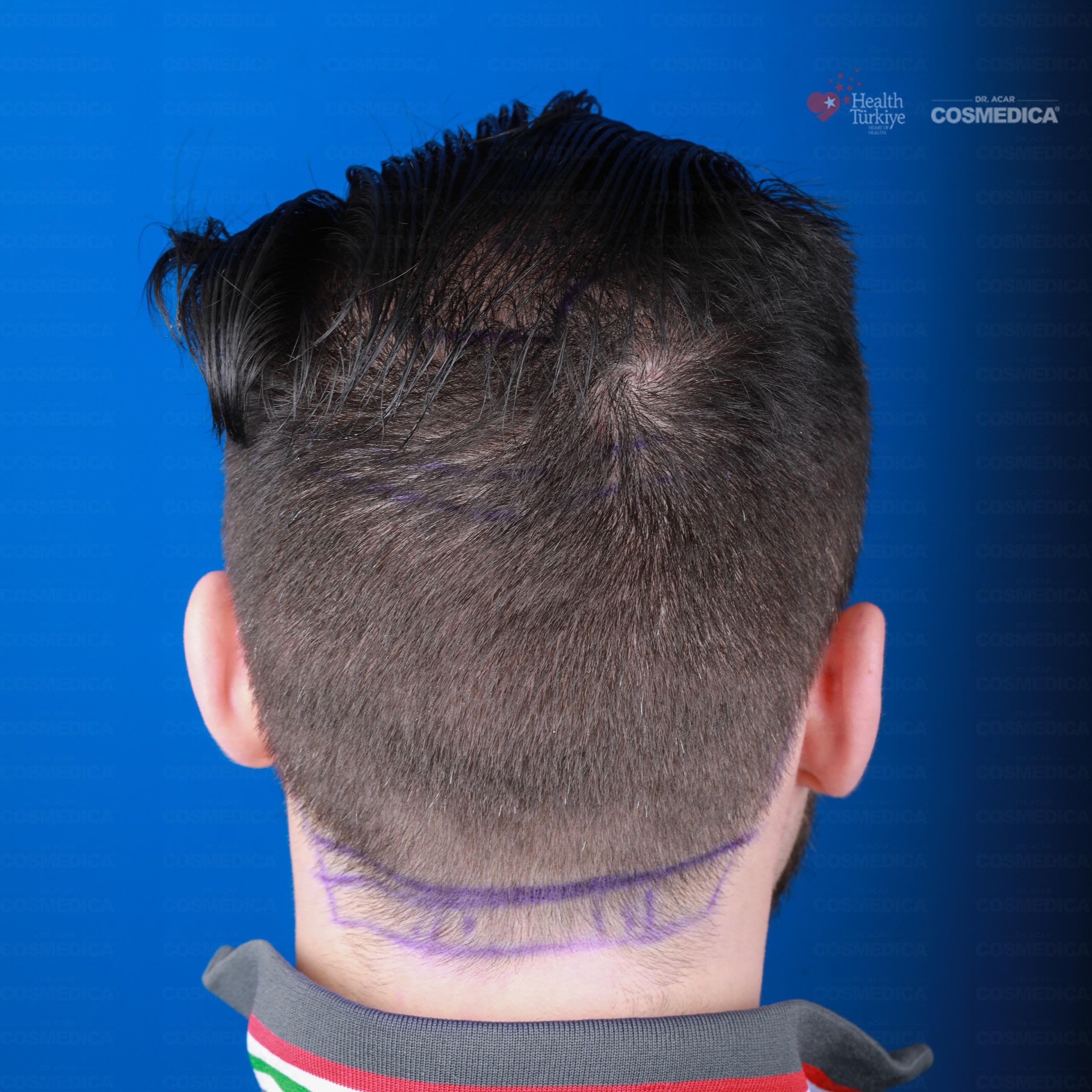 5500 graft DHI hair transplant result before and after