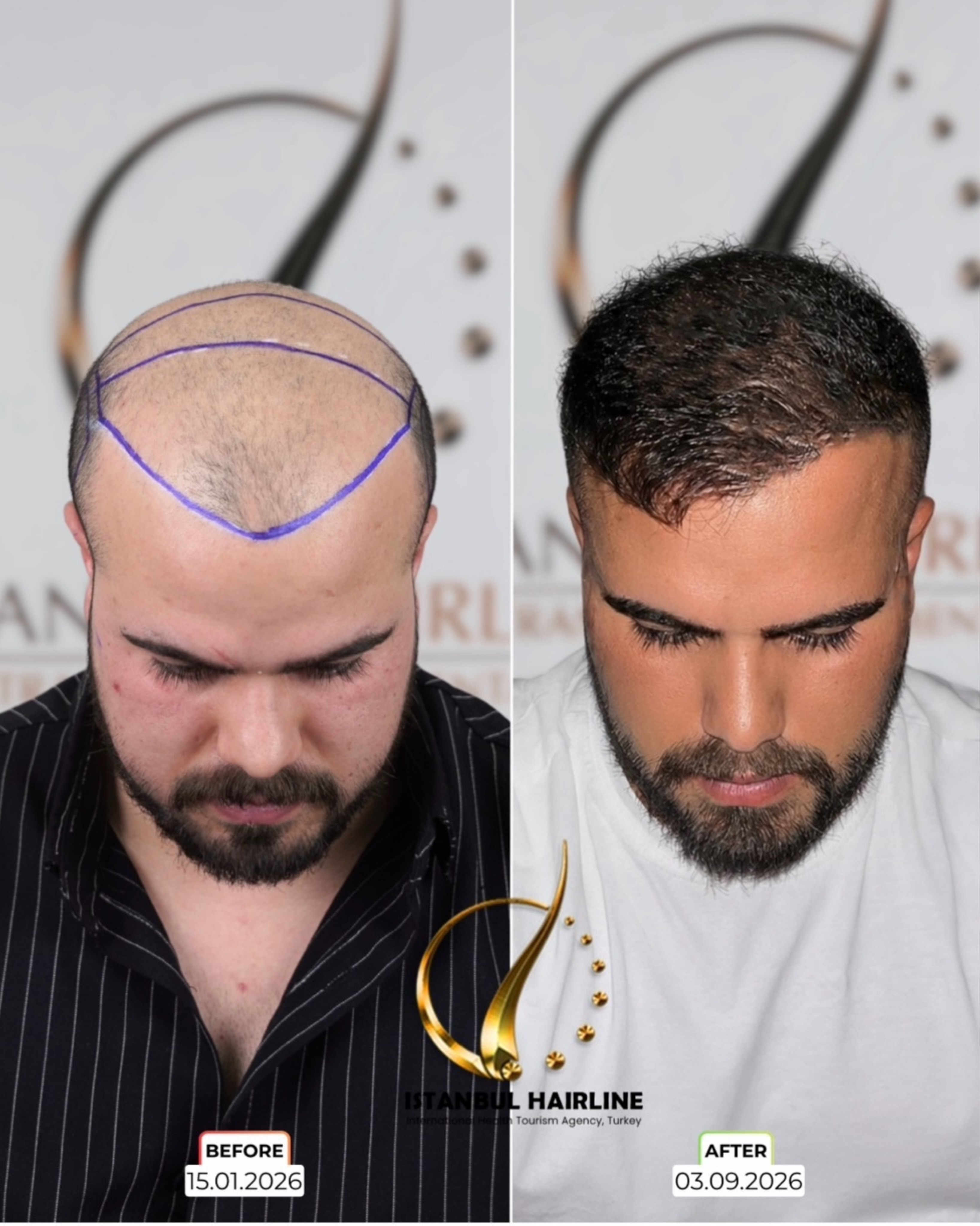 Before and After  graft    transplant at 