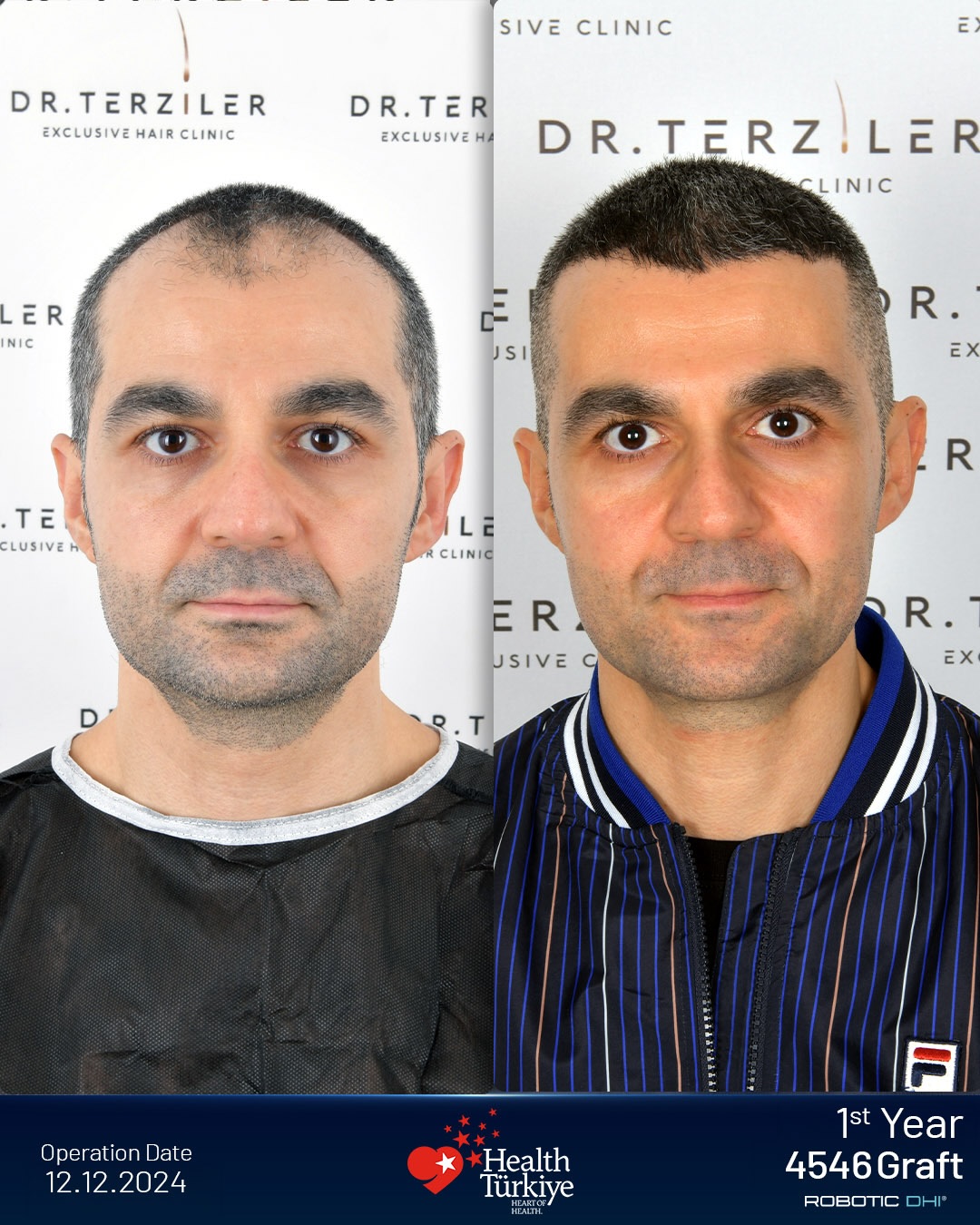 FUE Hair Transplant Result