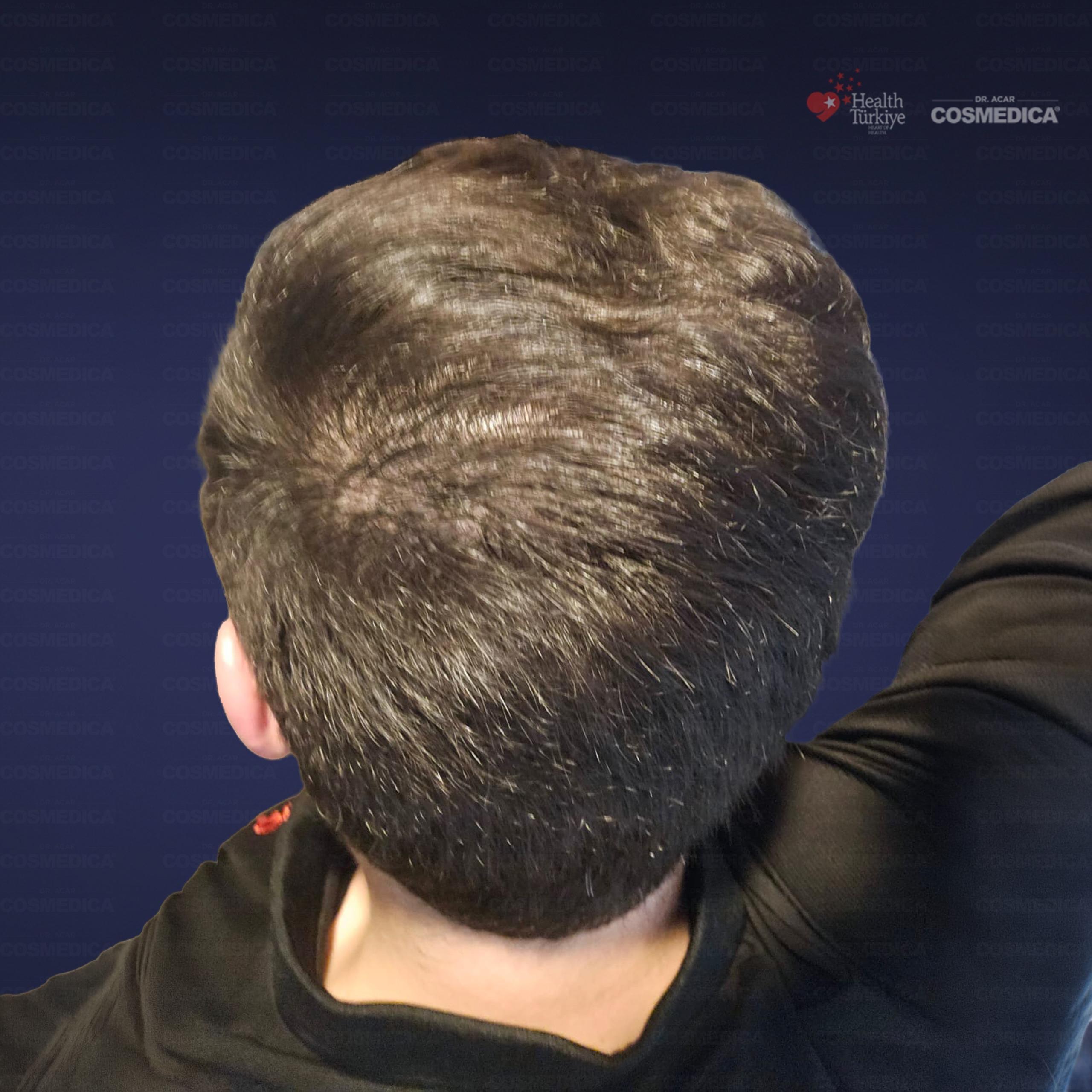 5500 graft DHI hair transplant result before and after