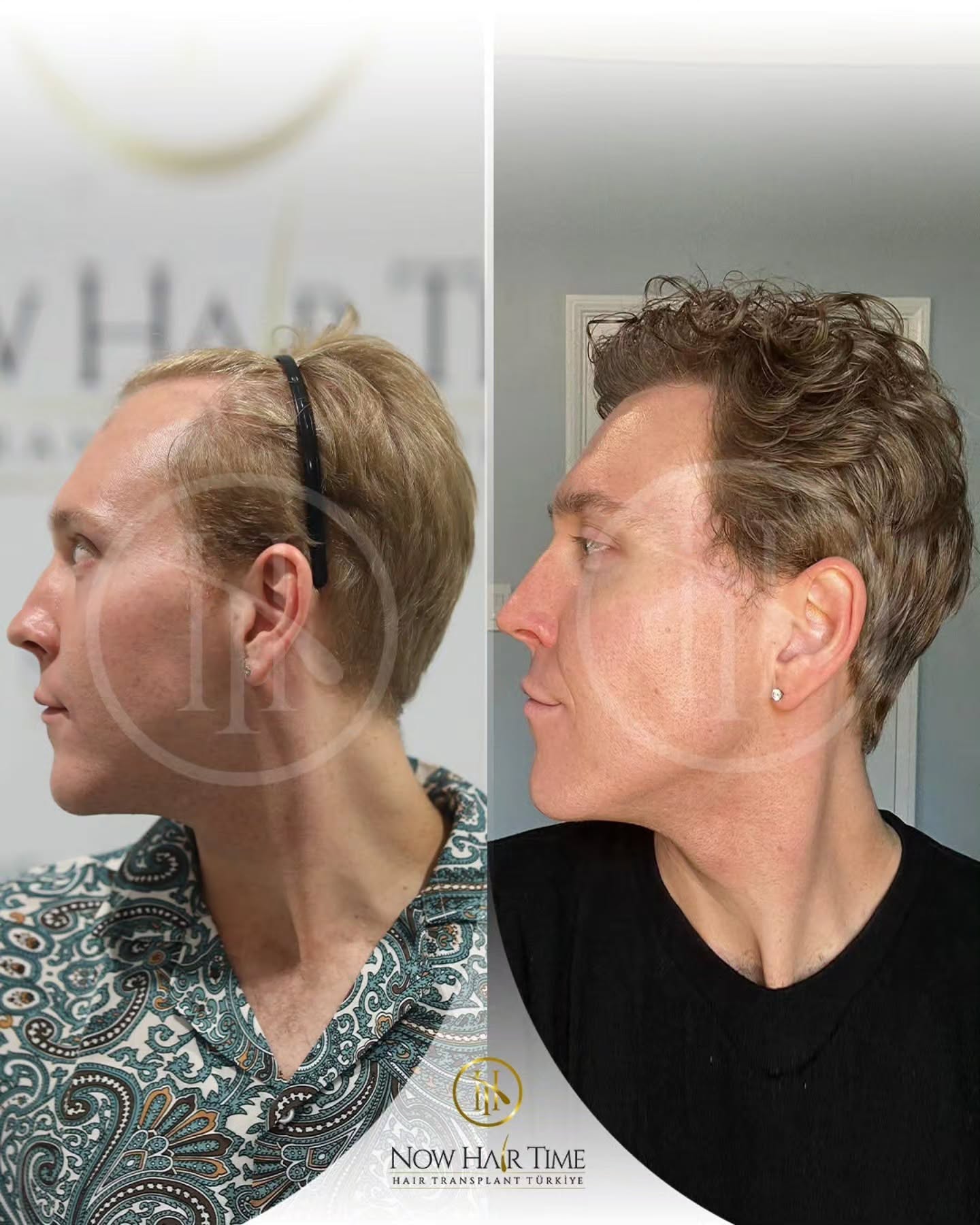 Before and After  graft    transplant at 